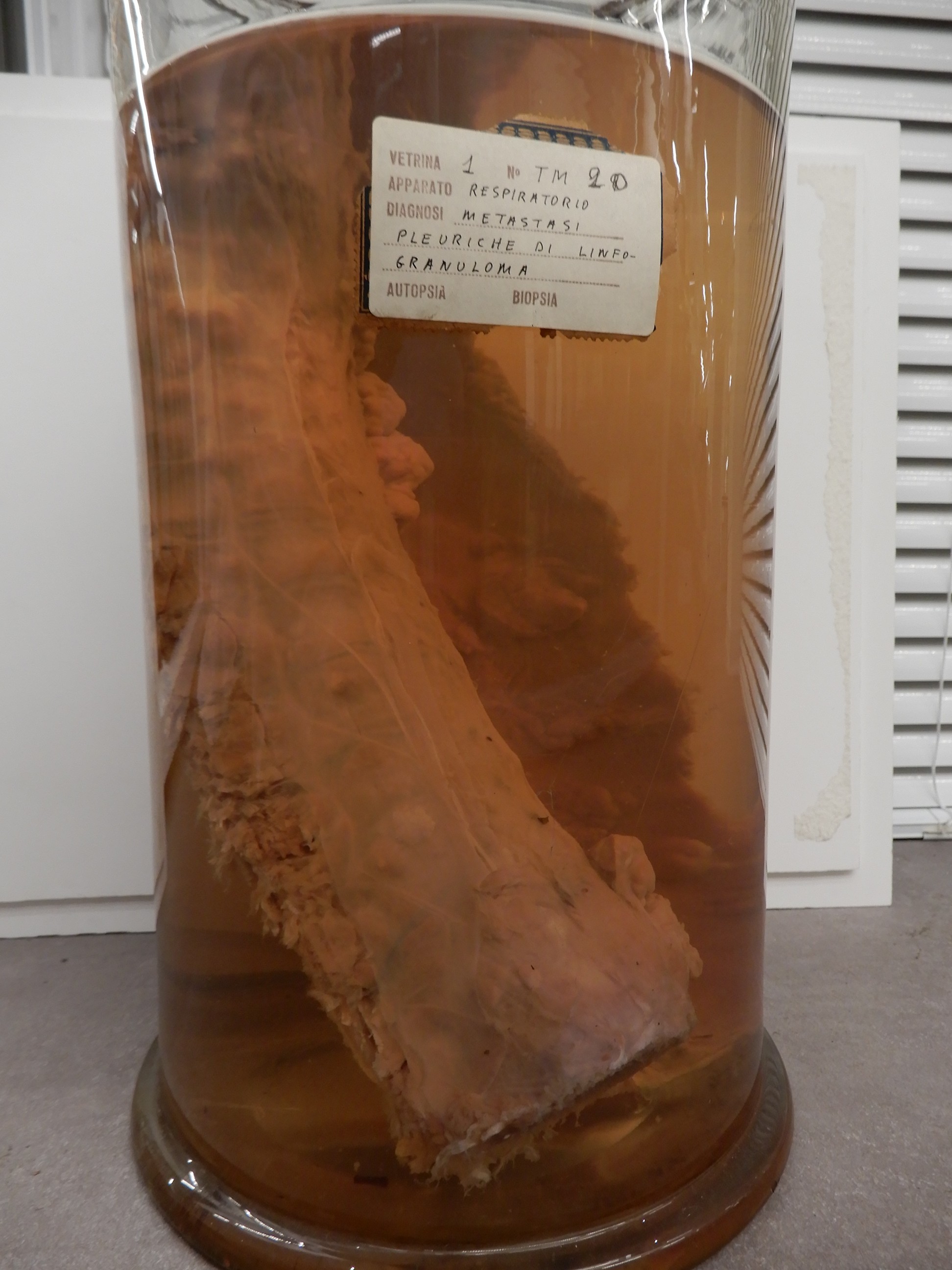 singolo reperto antropologico, preparato anatomico (morfologia alterata per patologia) (XIX-XX)