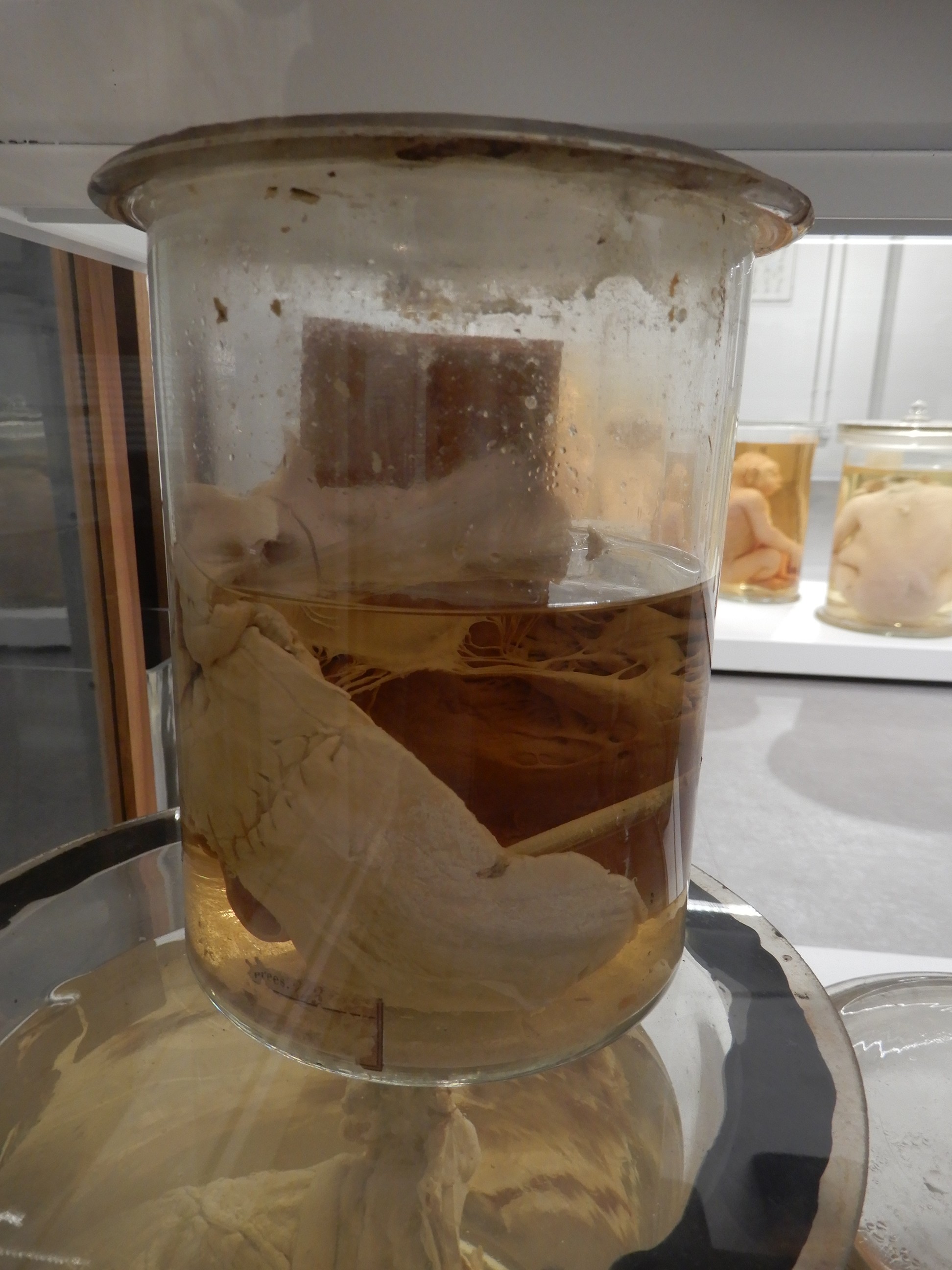 singolo reperto antropologico, preparato anatomico (morfologia alterata per patologia) (XIX-XX)