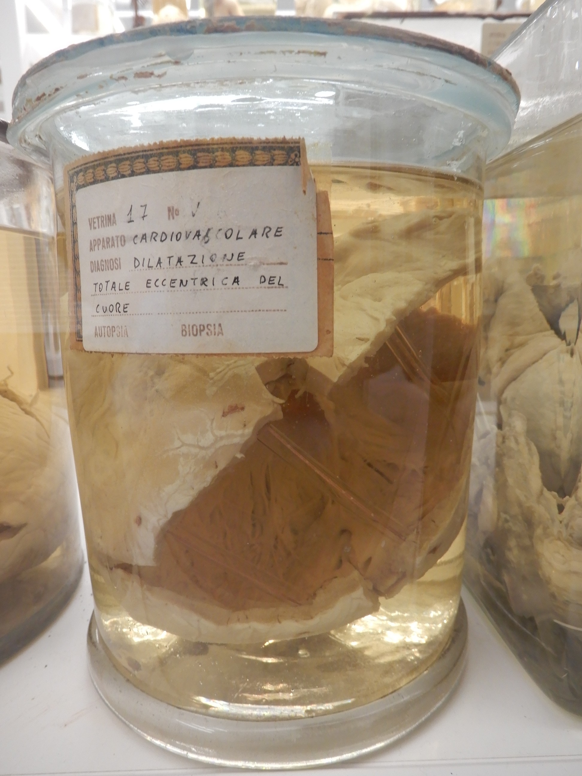 singolo reperto antropologico, preparato anatomico (morfologia alterata per patologia) (XIX-XX)