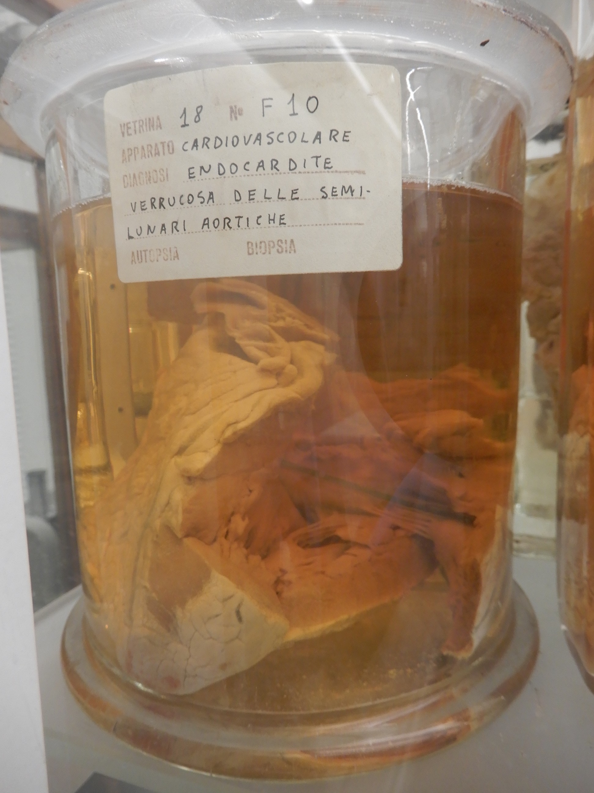 singolo reperto antropologico, preparato anatomico (morfologia alterata per patologia) (XIX-XX)