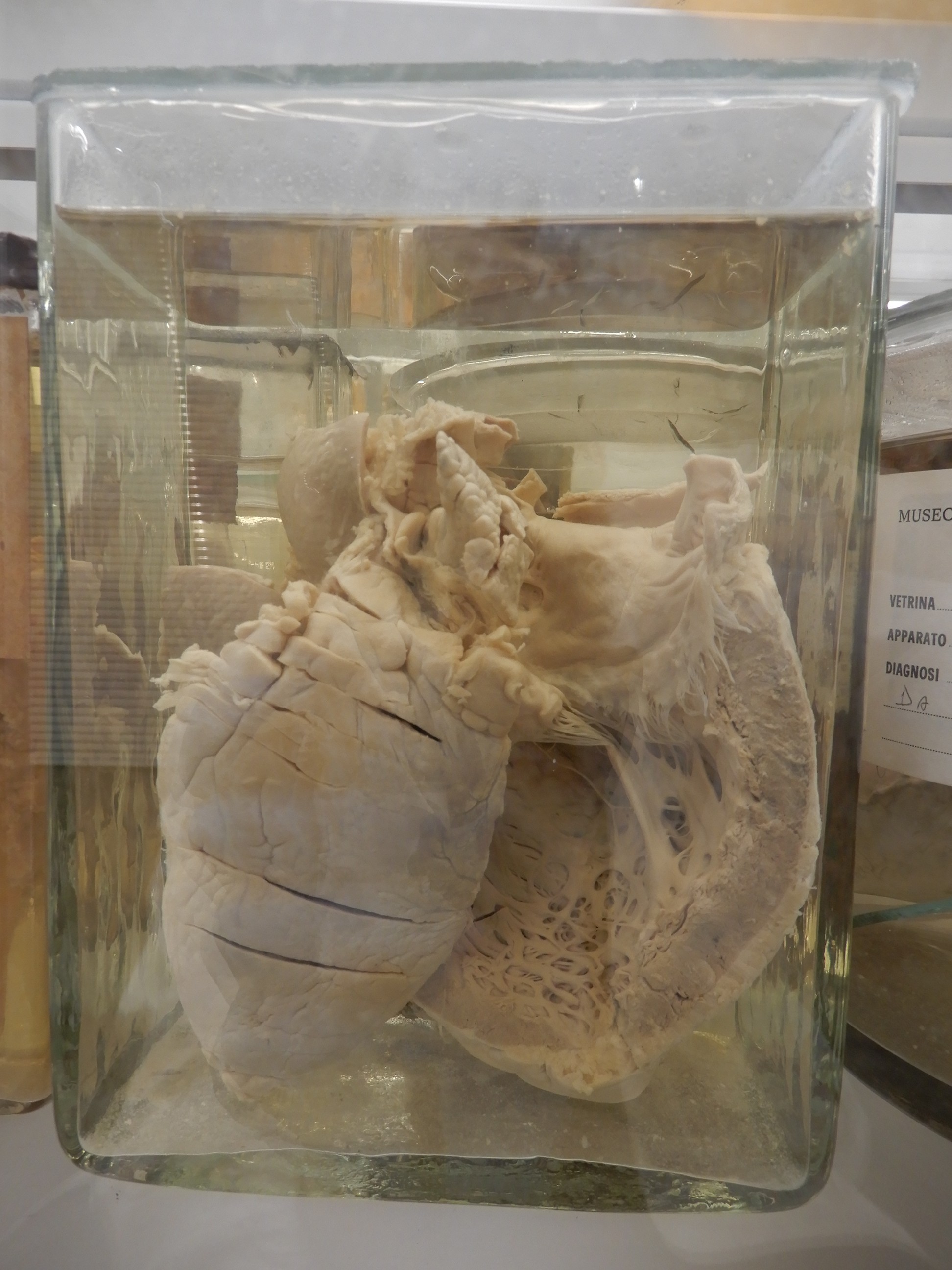 singolo reperto antropologico, preparato anatomico (morfologia alterata per patologia) (XIX-XX)