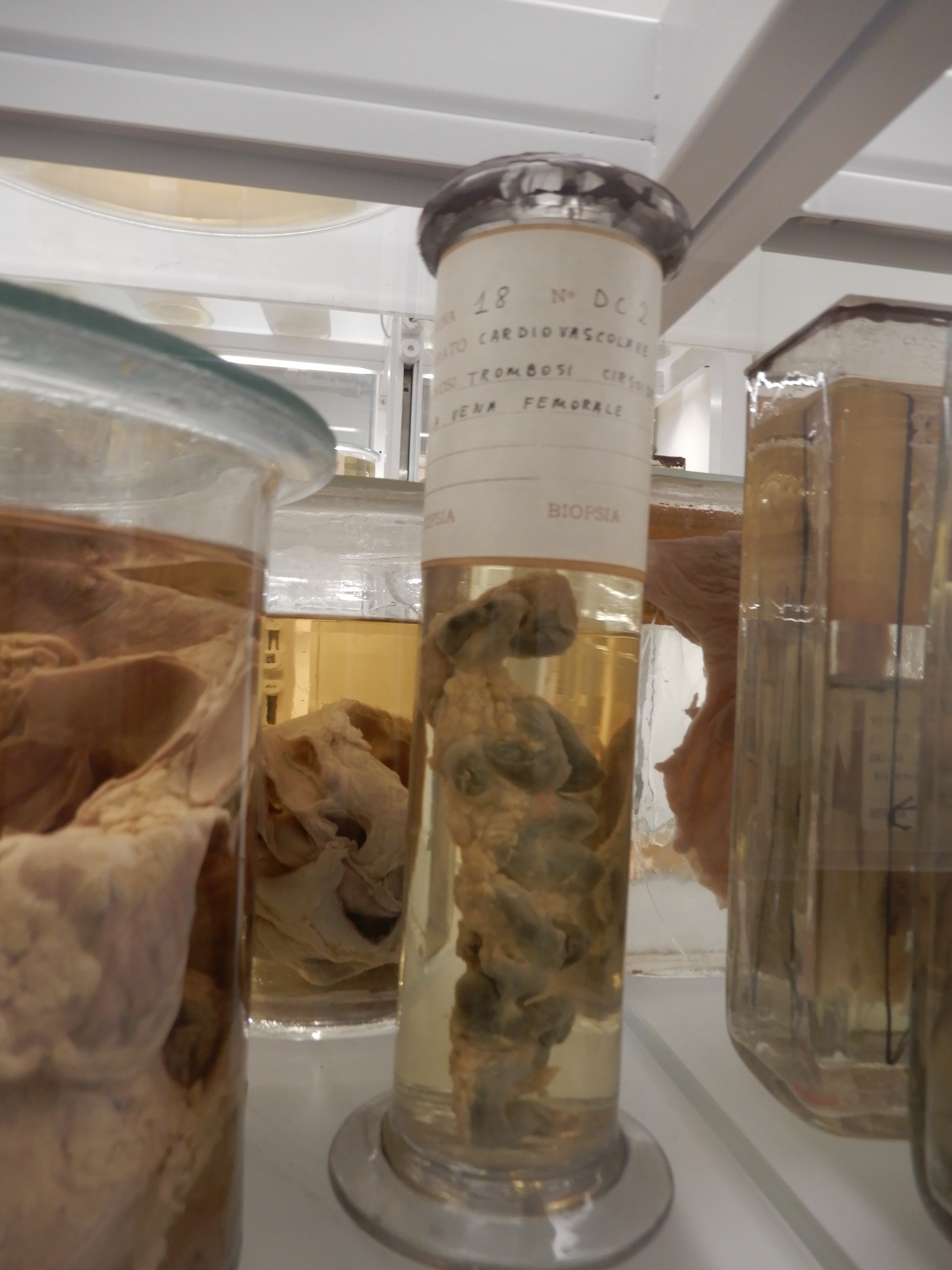 singolo reperto antropologico, preparato anatomico (morfologia alterata per patologia) (XIX-XX)