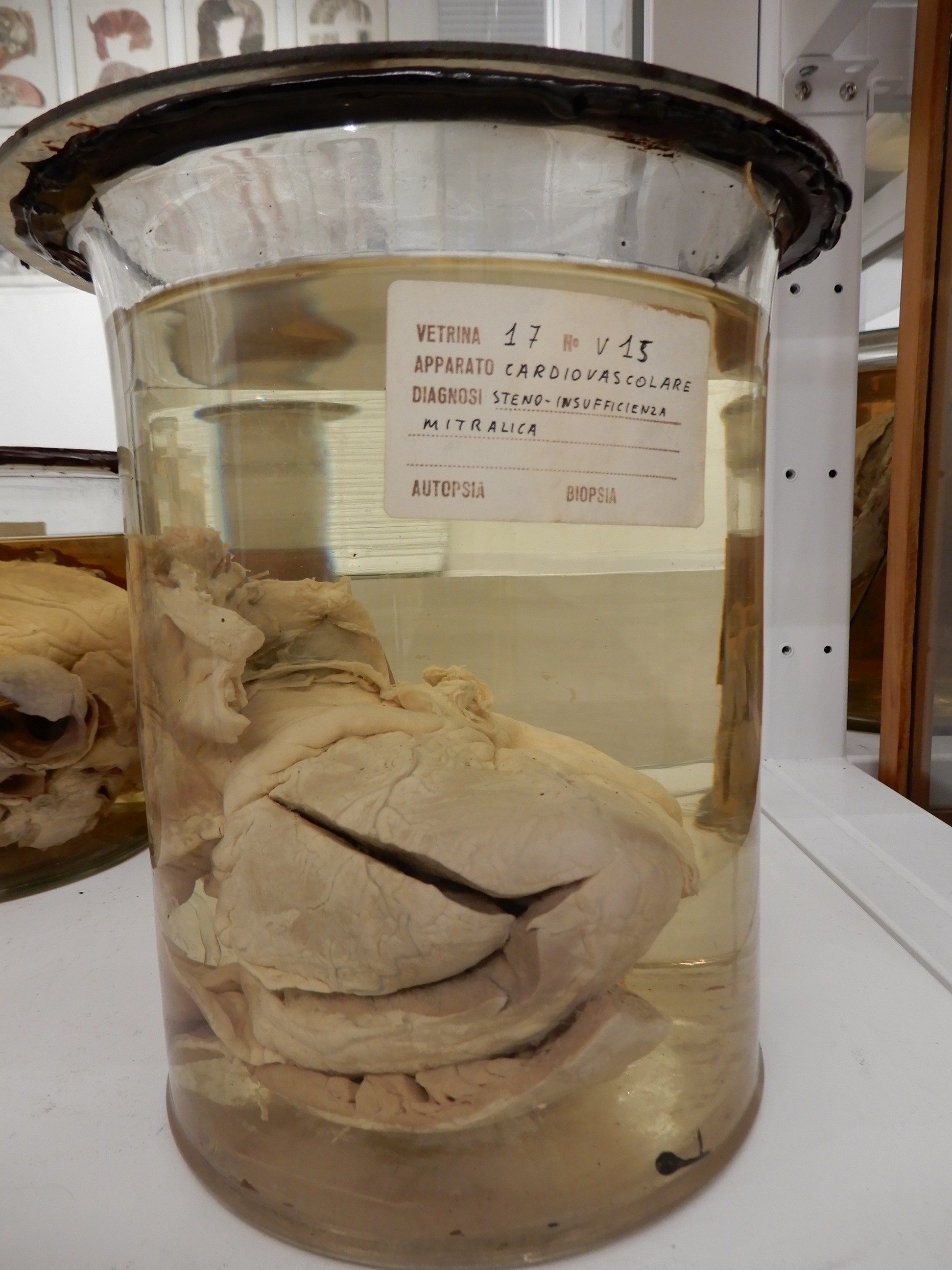 singolo reperto antropologico, preparato anatomico (morfologia alterata per patologia) (XIX-XX)