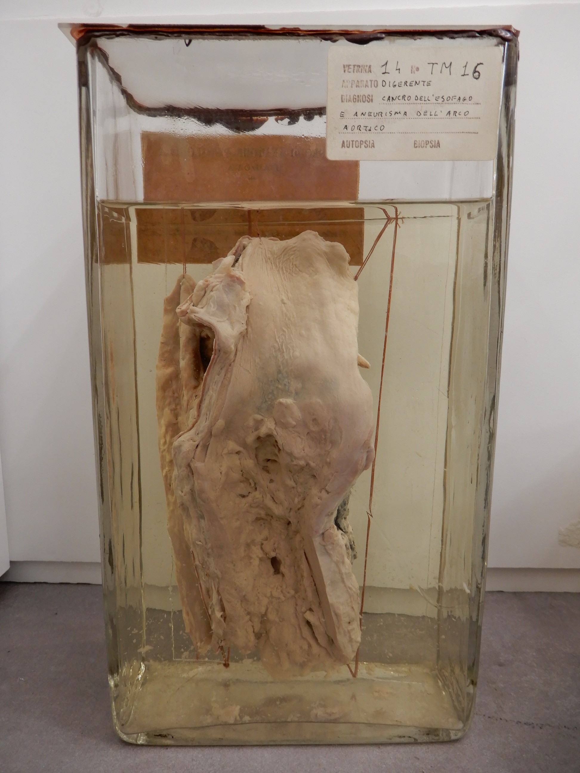 singolo reperto antropologico, preparato anatomico (morfologia alterata per patologia) (XIX-XX)