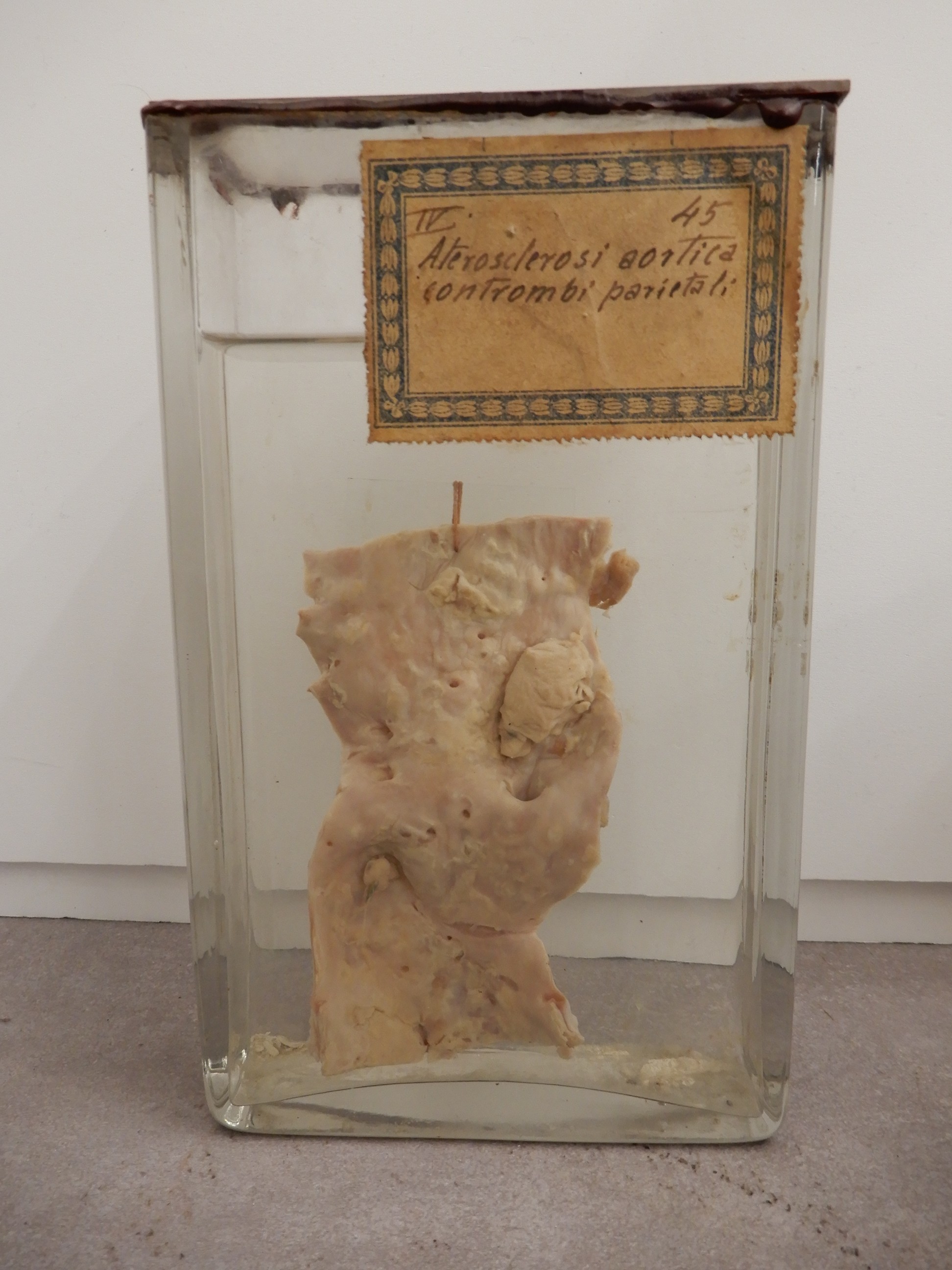 singolo reperto antropologico, preparato anatomico (morfologia alterata per patologia) (XIX-XX)