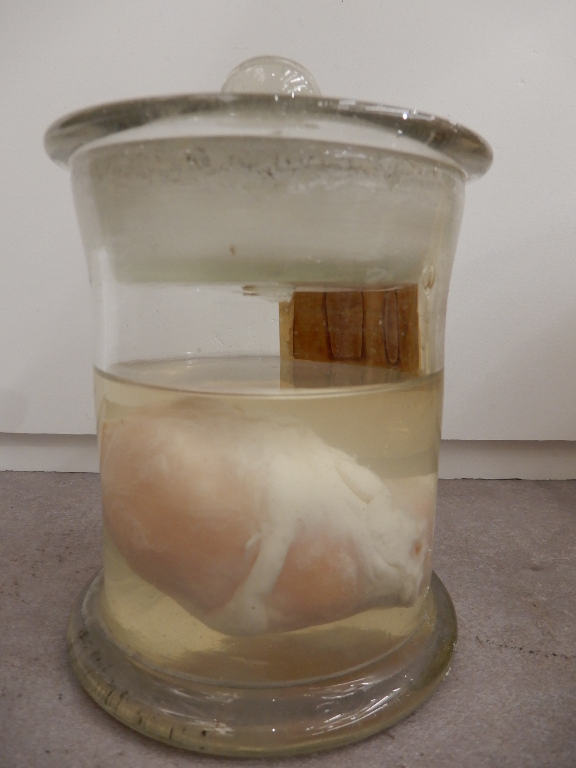 singolo reperto antropologico, preparato anatomico (morfologia alterata per patologia) (XIX-XX)