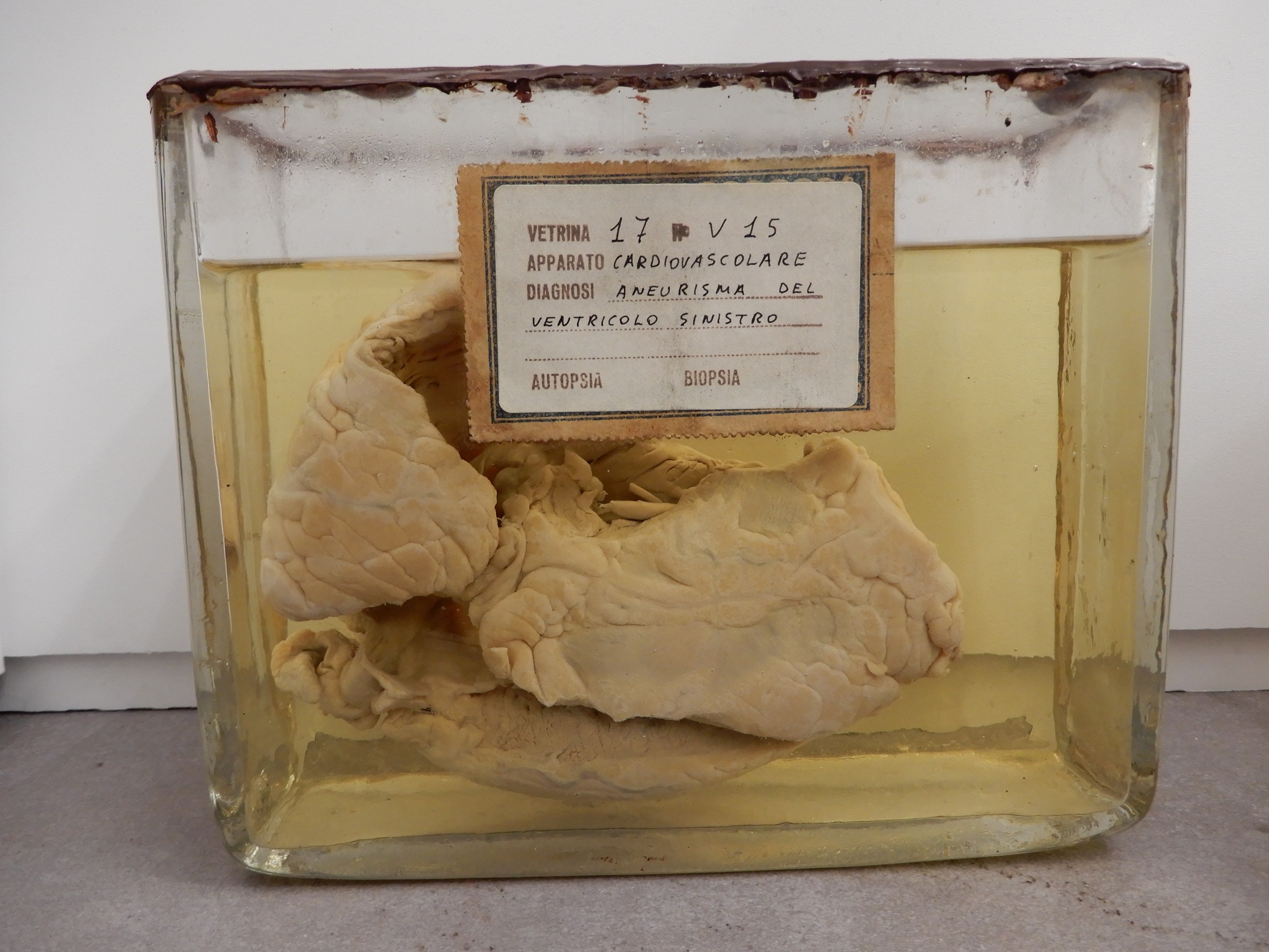 singolo reperto antropologico, preparato anatomico (morfologia alterata per patologia) (XIX-XX)