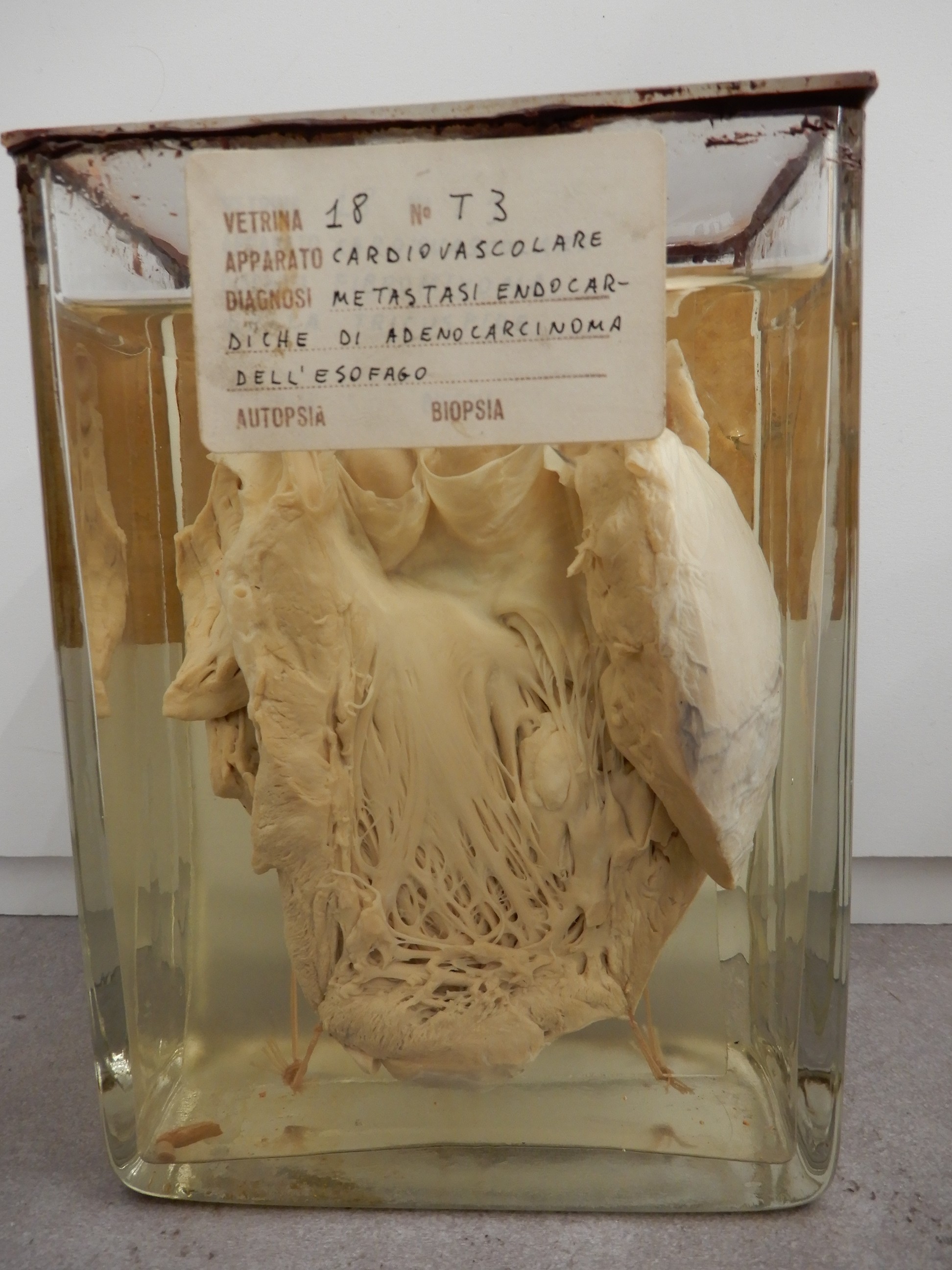 singolo reperto antropologico, preparato anatomico (morfologia alterata per patologia) (XIX-XX)