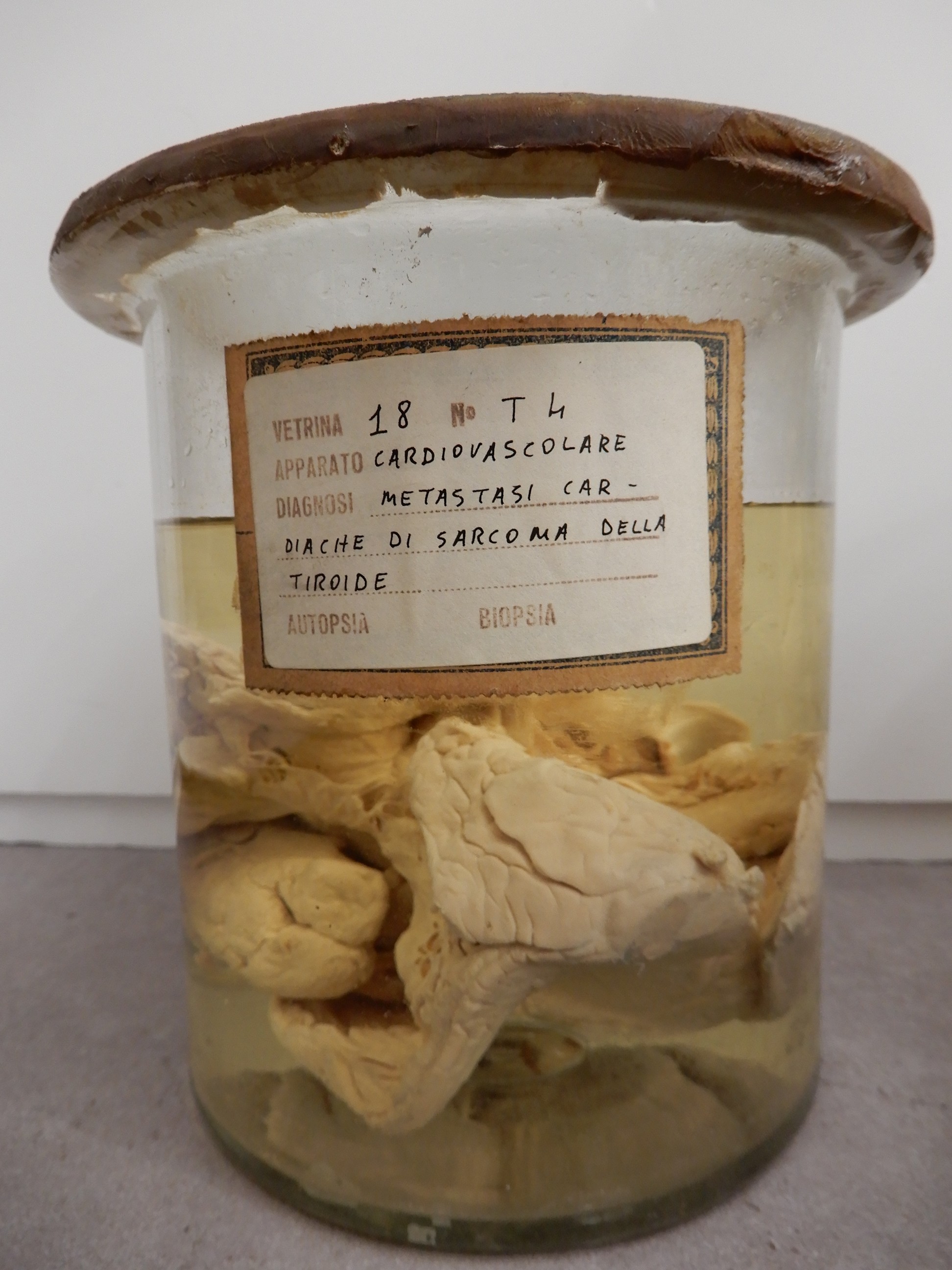 singolo reperto antropologico, preparato anatomico (morfologia alterata per patologia) (XIX-XX)