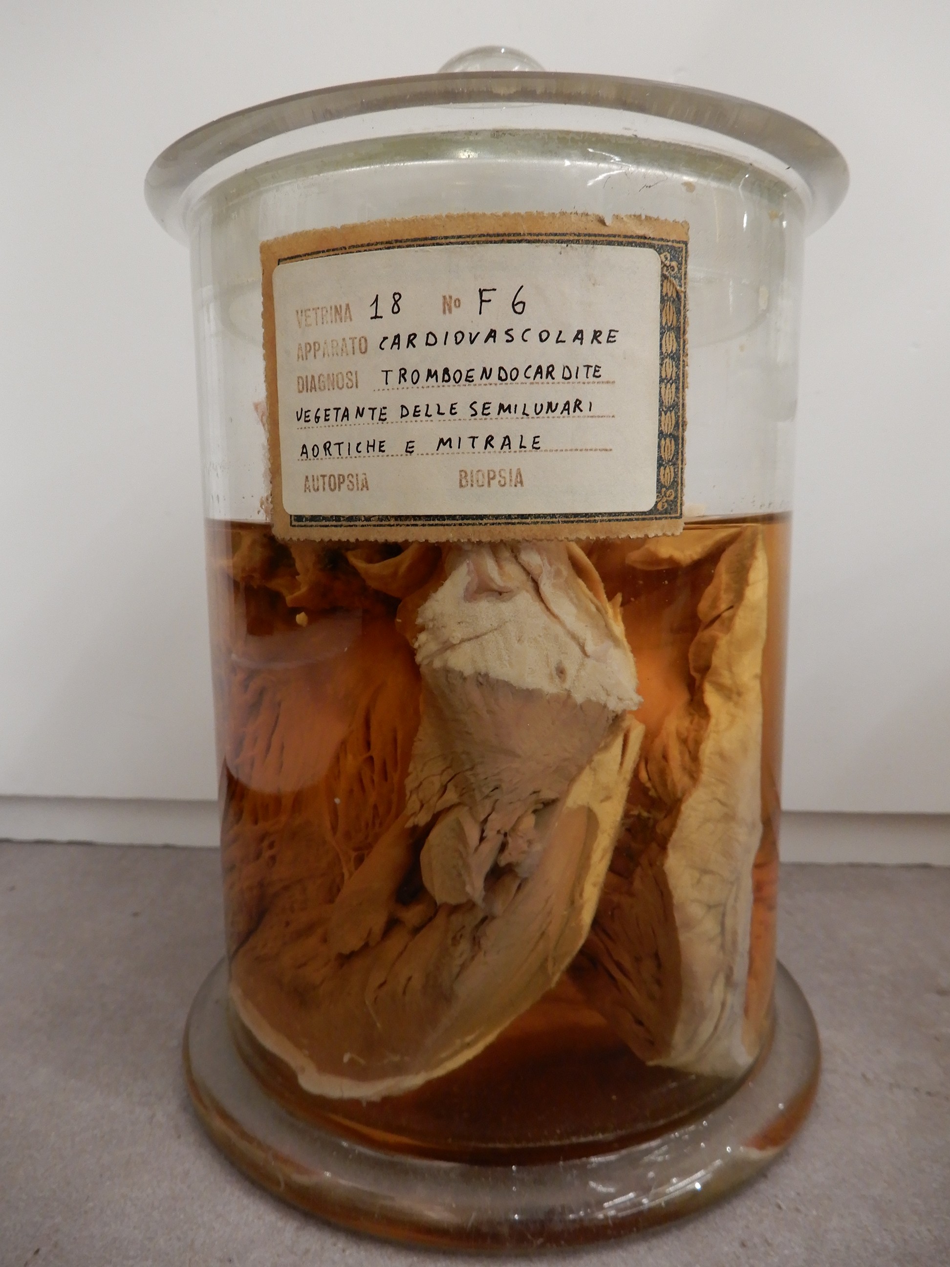 singolo reperto antropologico, preparato anatomico (morfologia alterata per patologia) (XIX-XX)