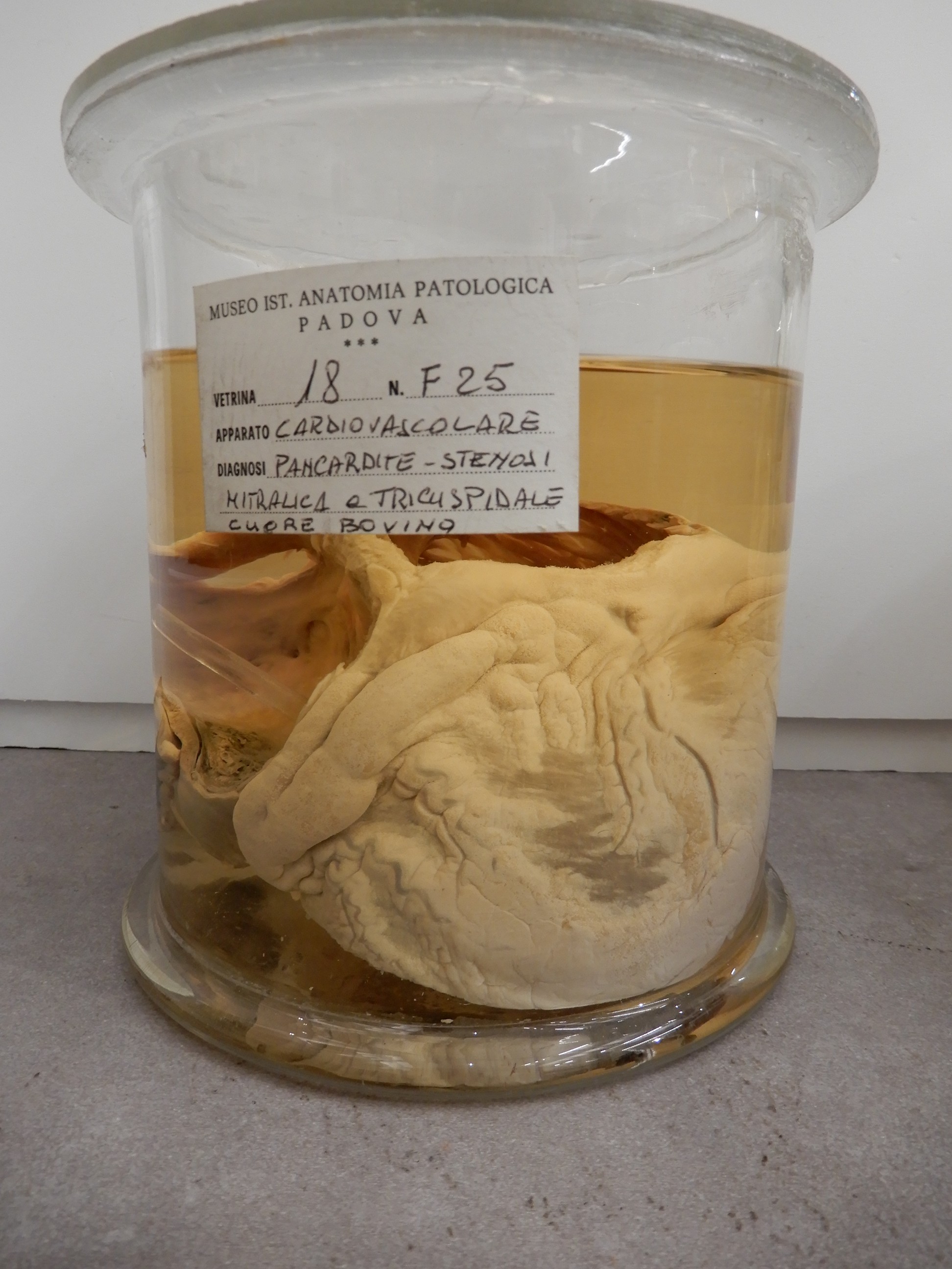 singolo reperto antropologico, preparato anatomico (morfologia alterata per patologia) (XIX-XX)