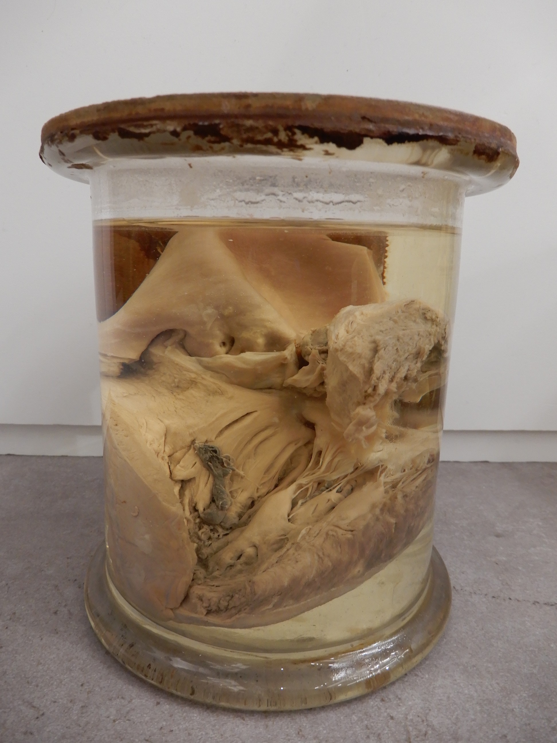 singolo reperto antropologico, preparato anatomico (morfologia alterata per patologia) (XIX-XX)