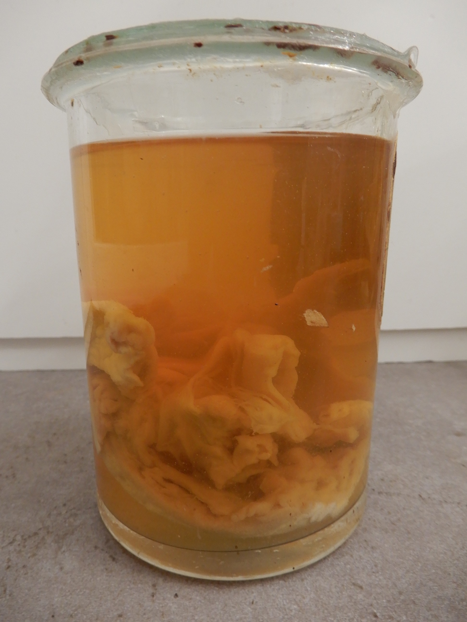 singolo reperto antropologico, preparato anatomico (morfologia alterata per patologia) (XIX-XX)