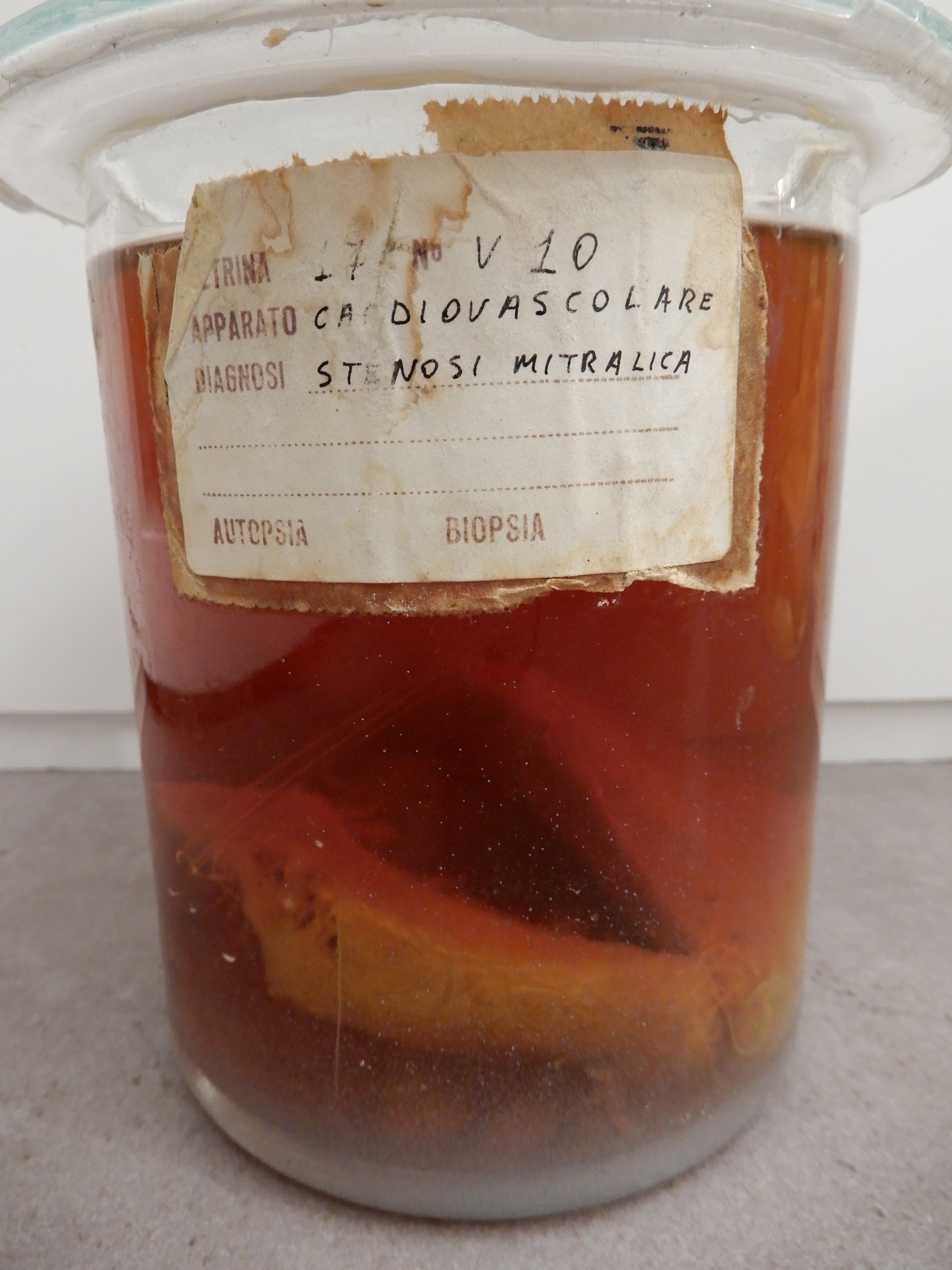 singolo reperto antropologico, preparato anatomico (morfologia alterata per patologia) (XIX-XX)