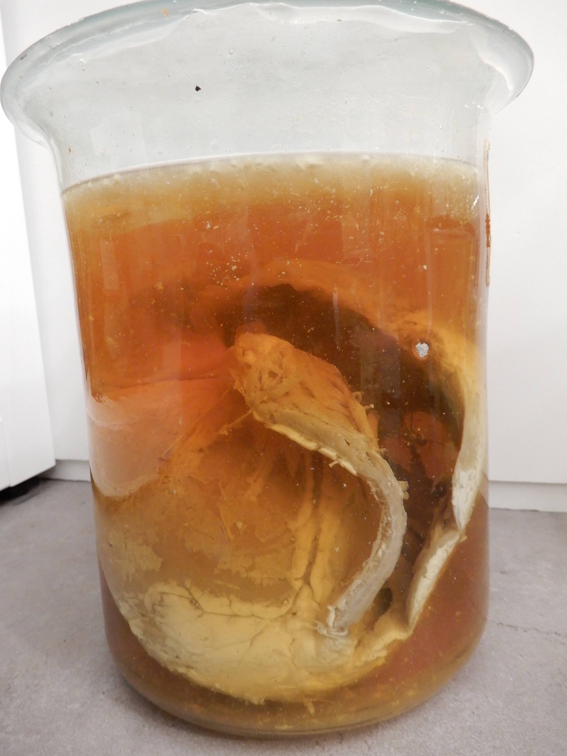 singolo reperto antropologico, preparato anatomico (morfologia alterata per patologia) (XIX-XX)