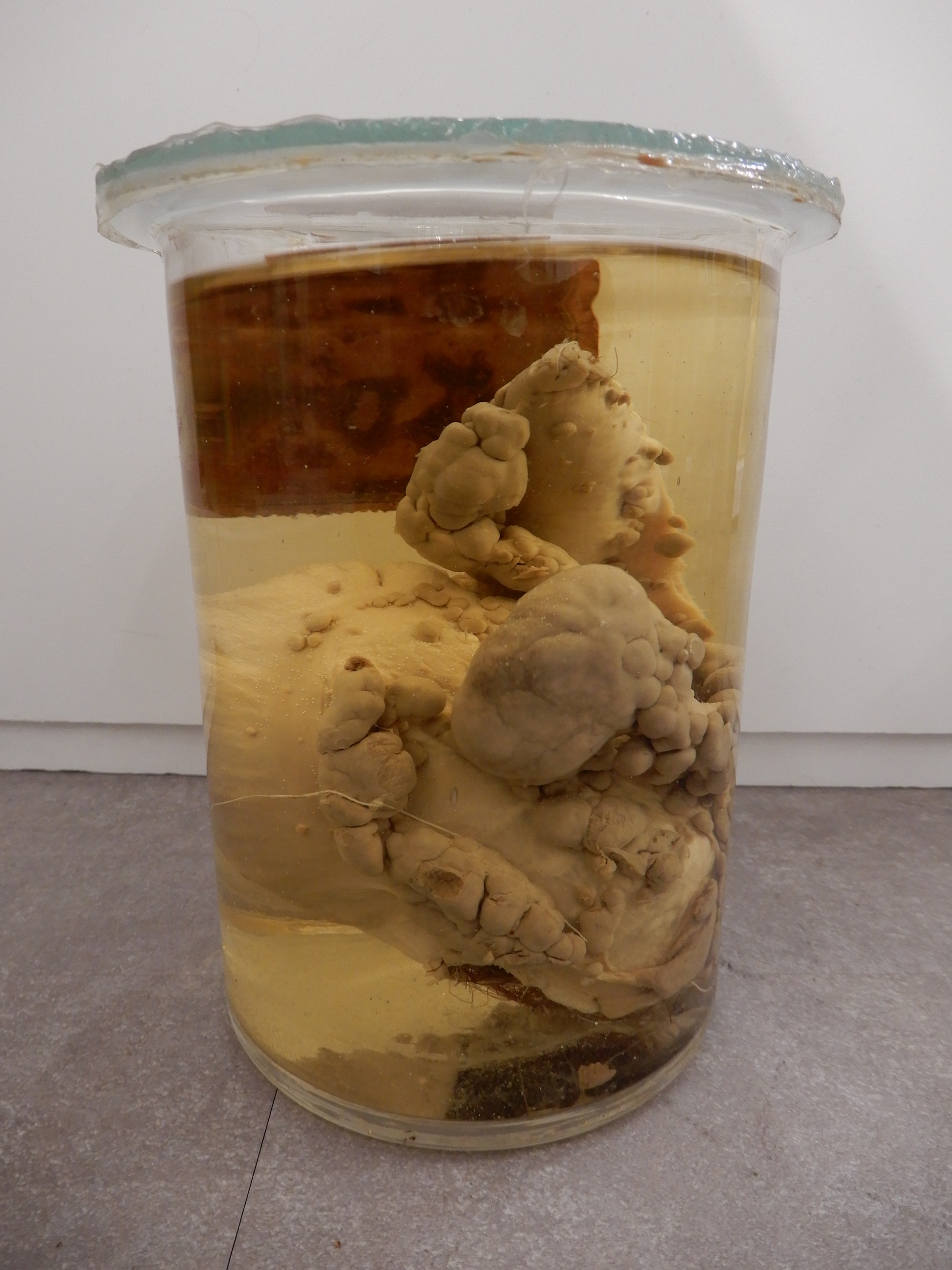 singolo reperto antropologico, preparato anatomico (morfologia alterata per patologia) (XIX-XX)