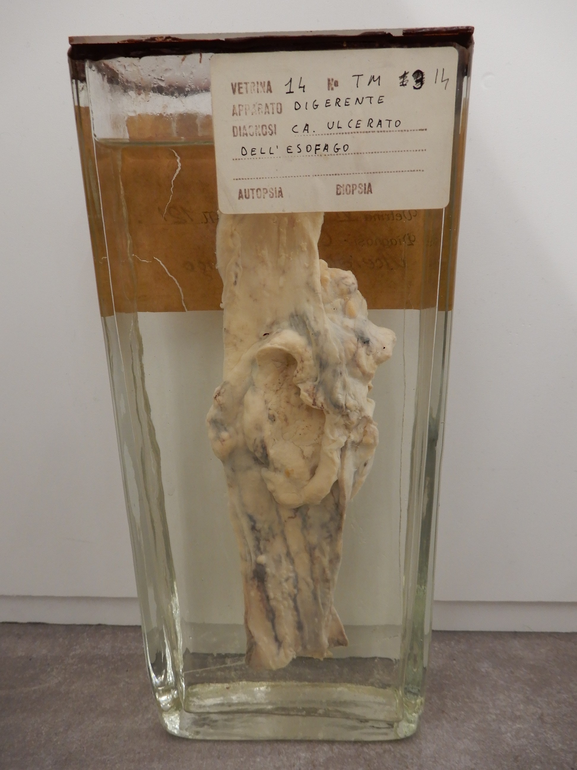 singolo reperto antropologico, preparato anatomico (morfologia alterata per patologia) (XIX-XX)