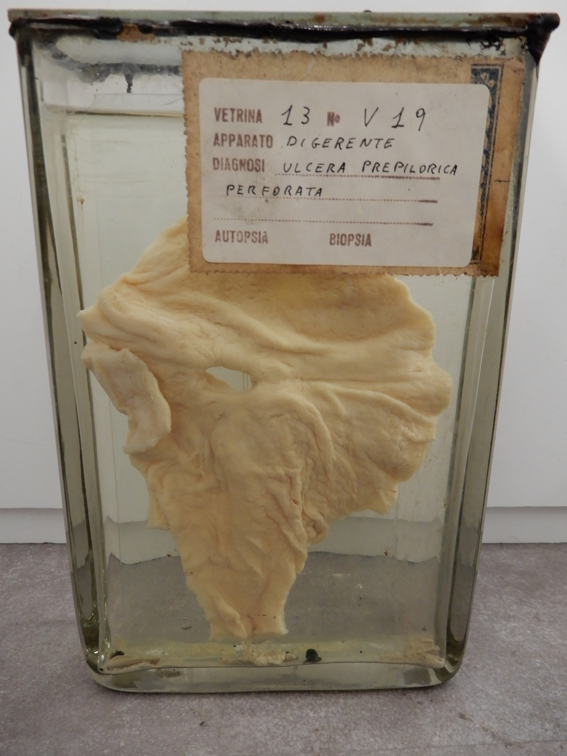 singolo reperto antropologico, preparato anatomico (morfologia alterata per patologia) (XIX-XX)