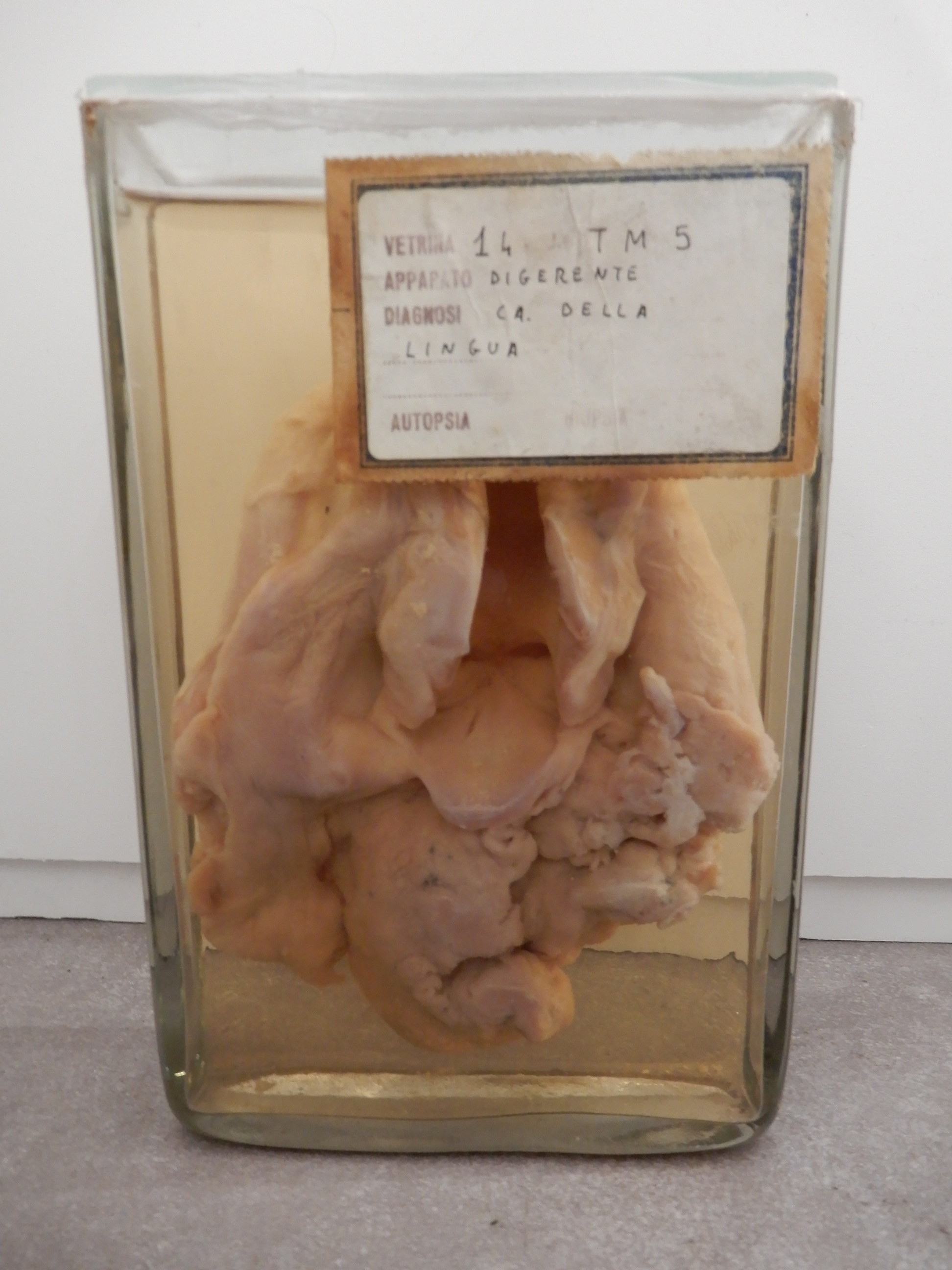 singolo reperto antropologico, preparato anatomico (morfologia alterata per patologia) (XIX-XX)