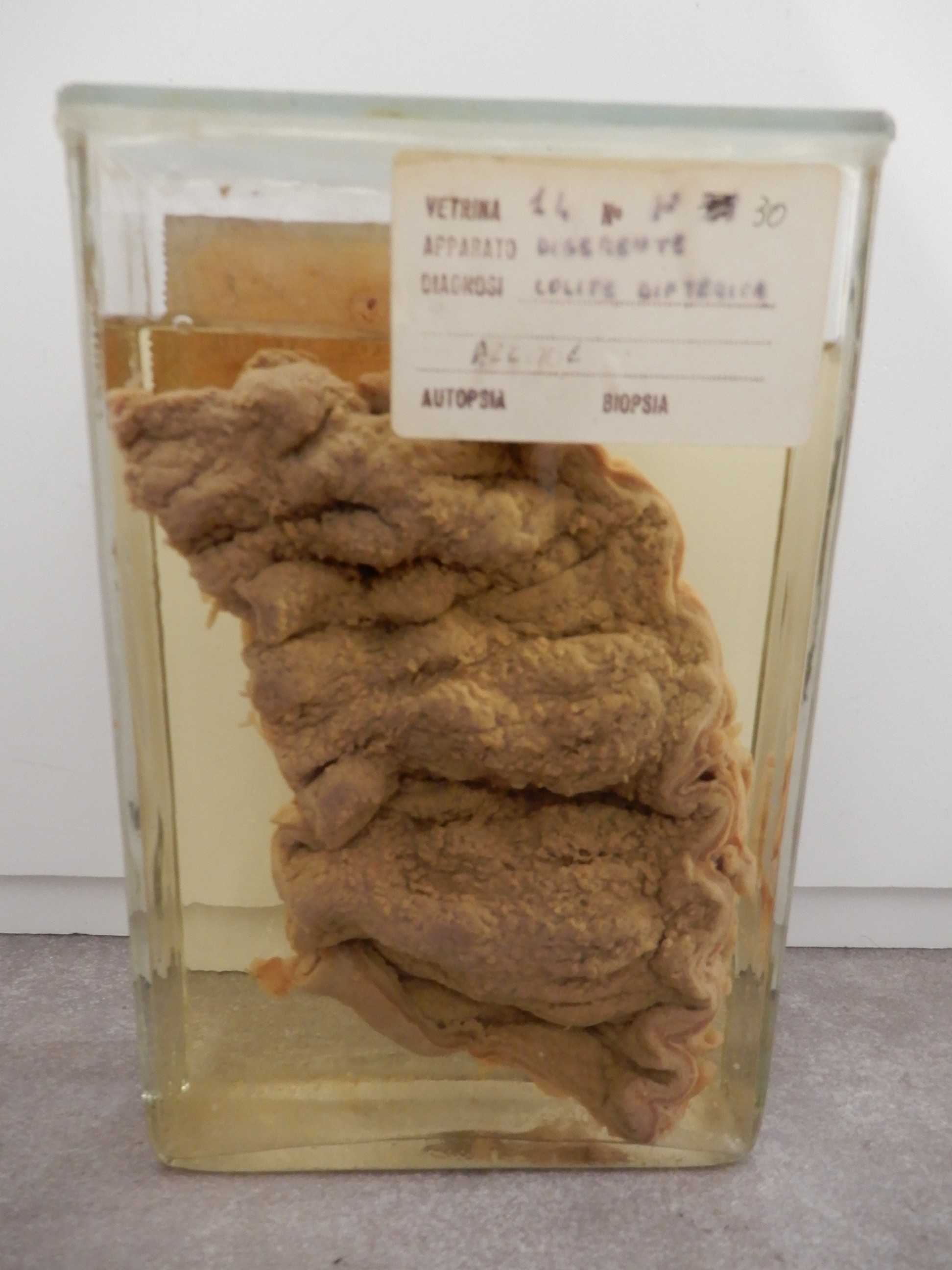 singolo reperto antropologico, preparato anatomico (morfologia alterata per patologia) (XIX-XX)