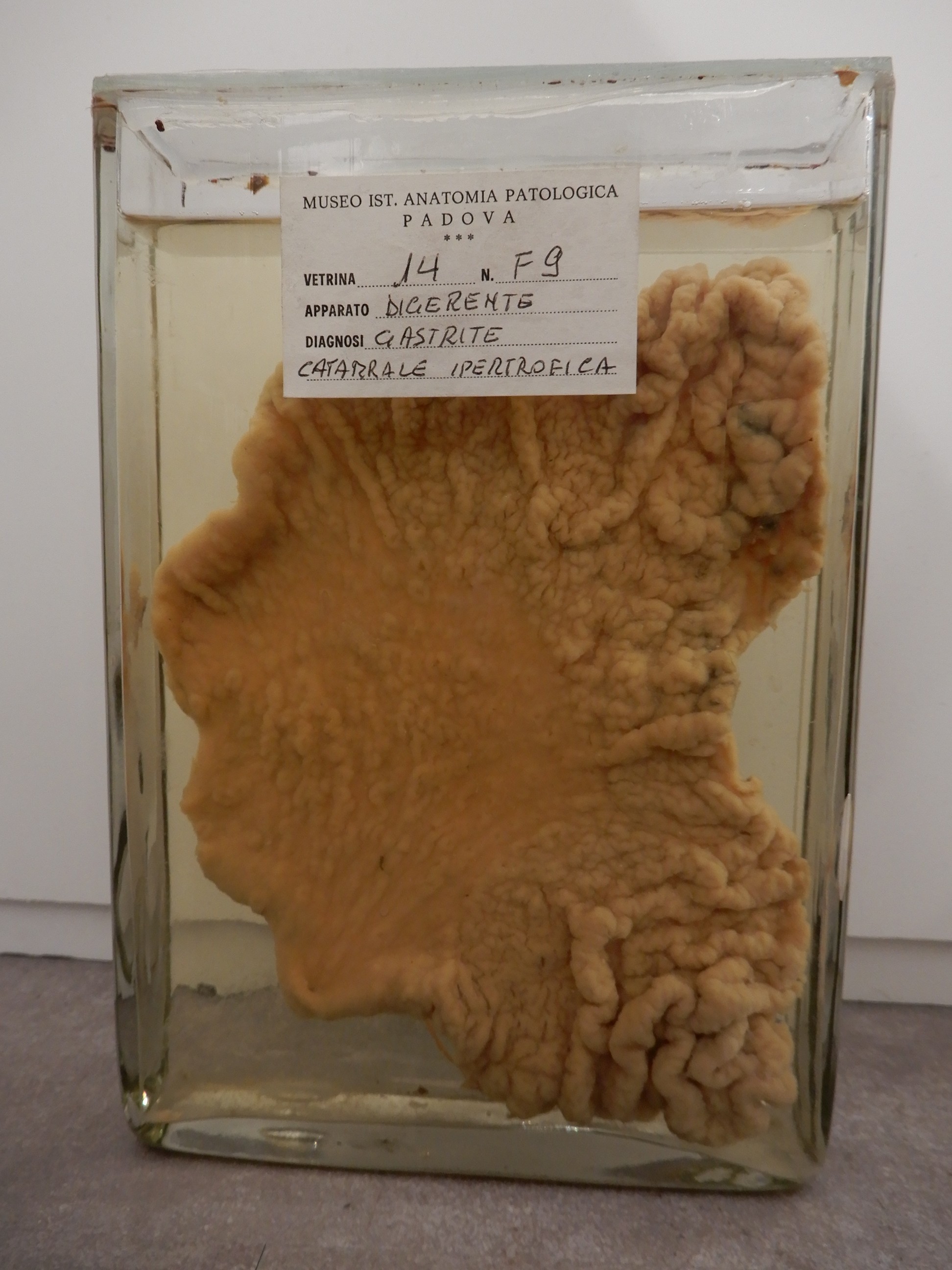 singolo reperto antropologico, preparato anatomico (morfologia alterata per patologia) (XIX-XX)