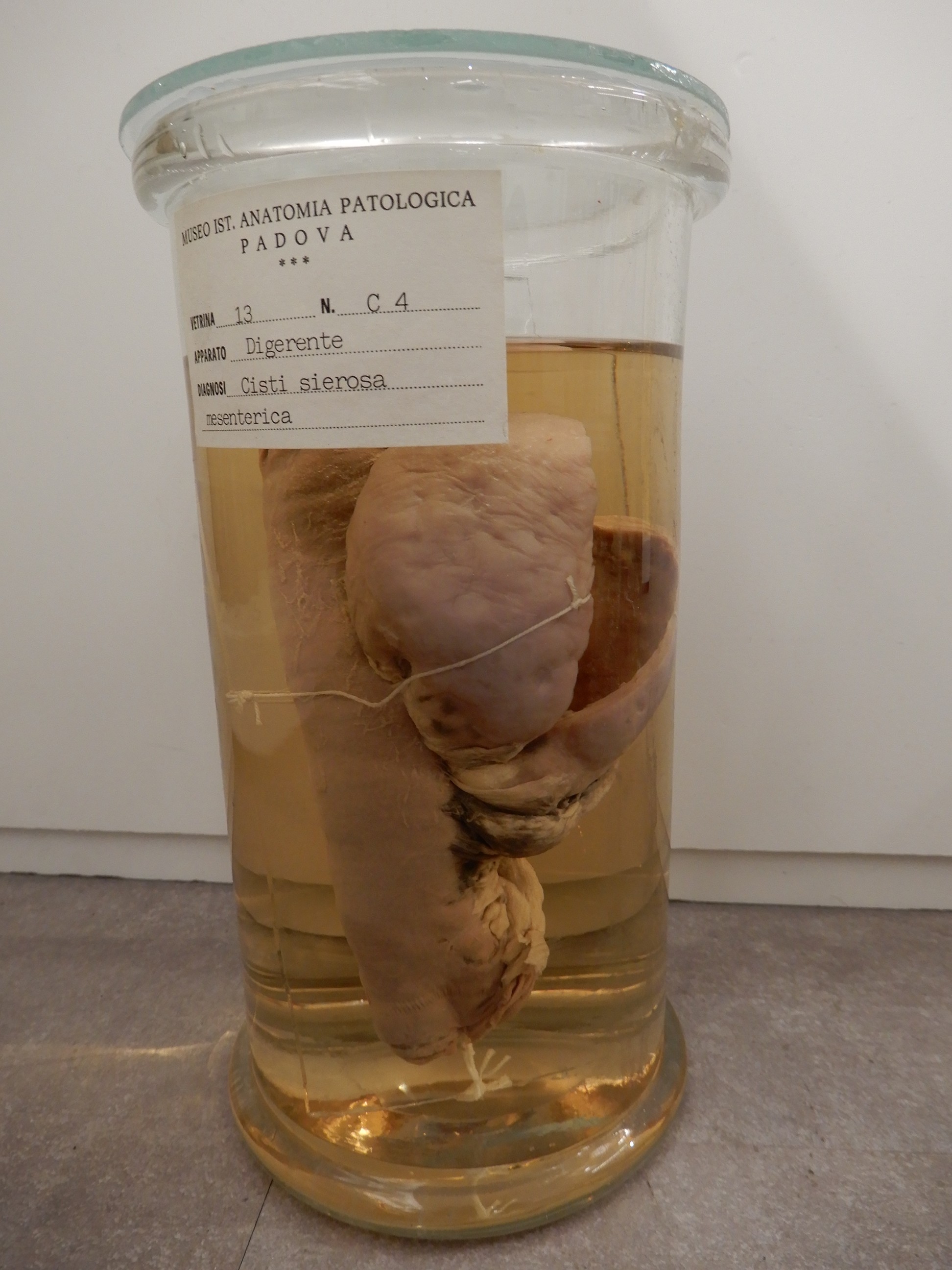singolo reperto antropologico, preparato anatomico (morfologia alterata per patologia) (XIX-XX)