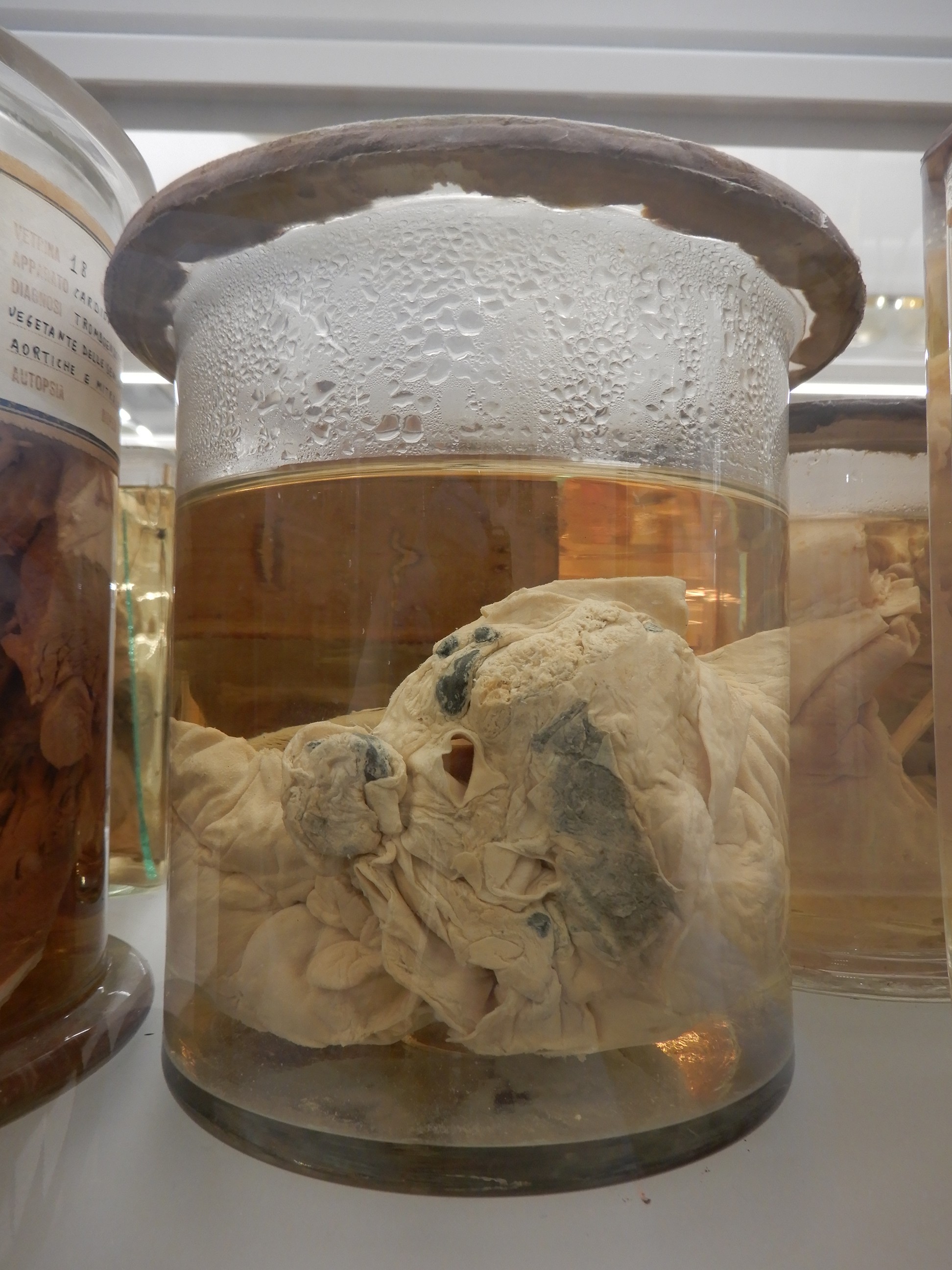 singolo reperto antropologico, preparato anatomico (morfologia alterata per patologia) (XIX-XX)