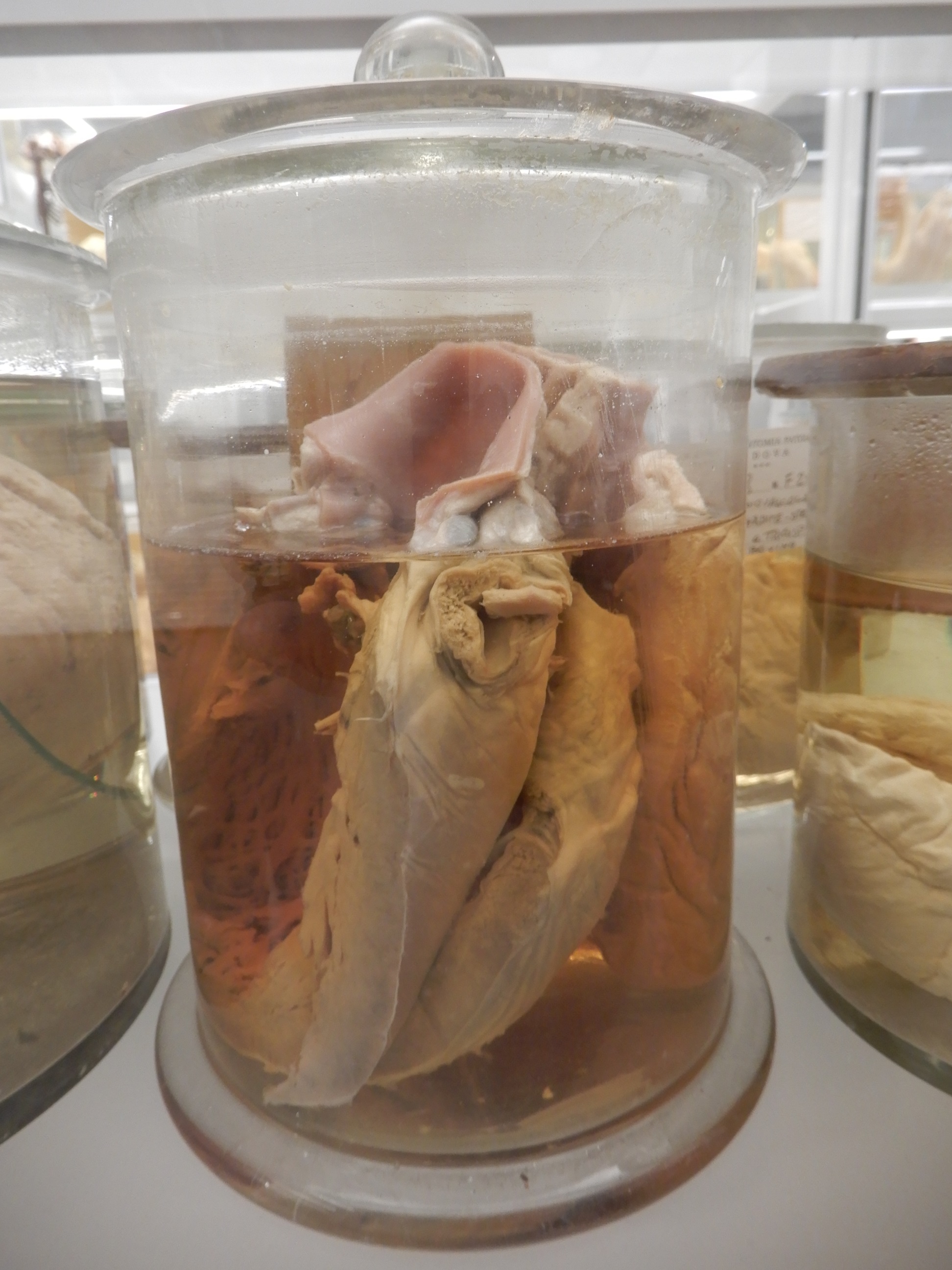 singolo reperto antropologico, preparato anatomico (morfologia alterata per patologia) (XIX-XX)