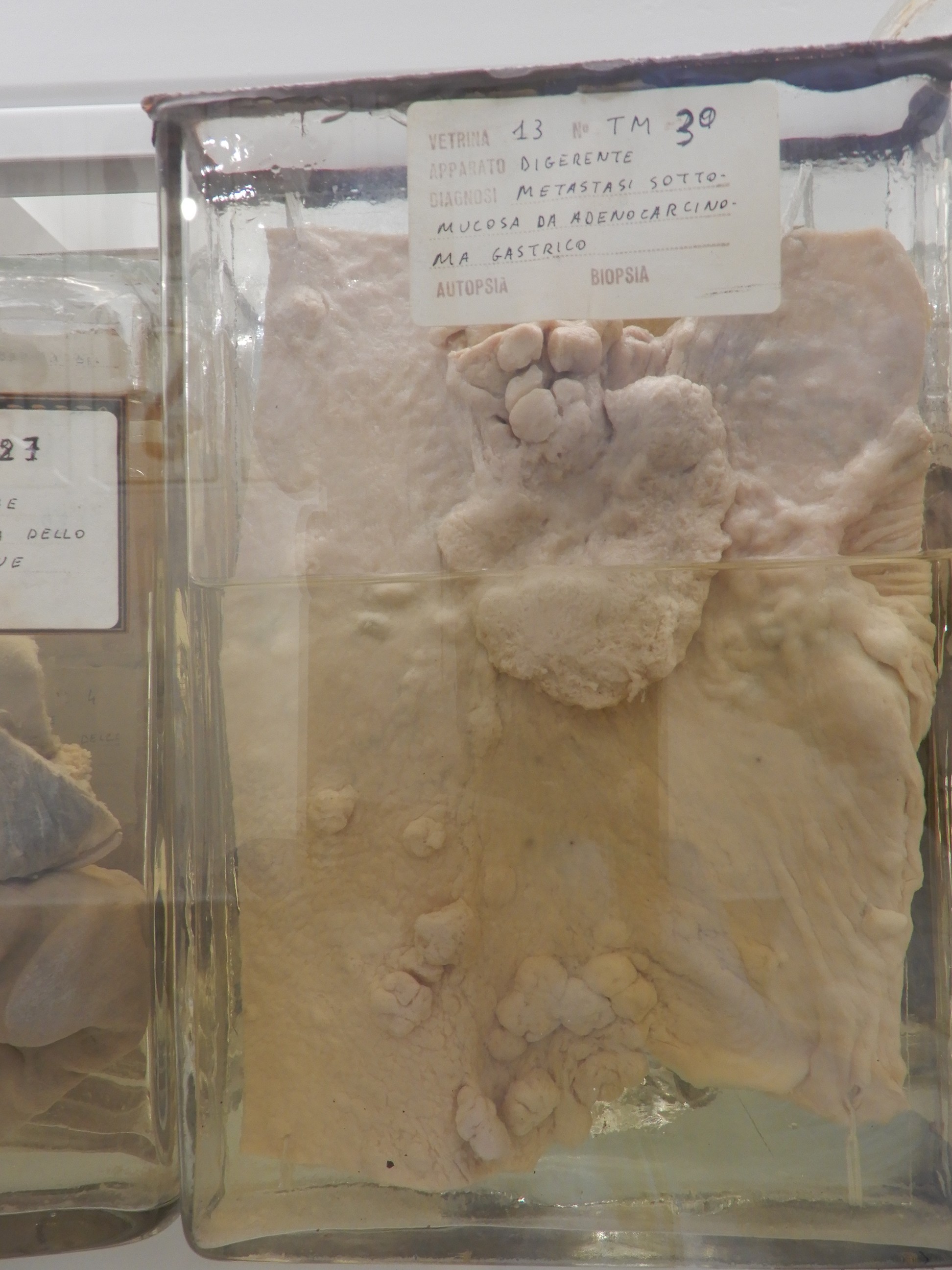 singolo reperto antropologico, preparato anatomico (morfologia alterata per patologia) (XIX-XX)