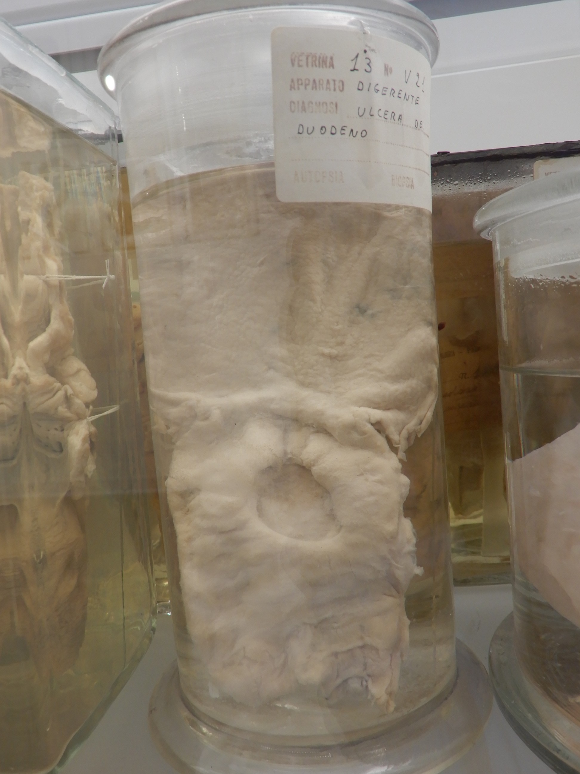 singolo reperto antropologico, preparato anatomico (morfologia alterata per patologia) (XIX-XX)