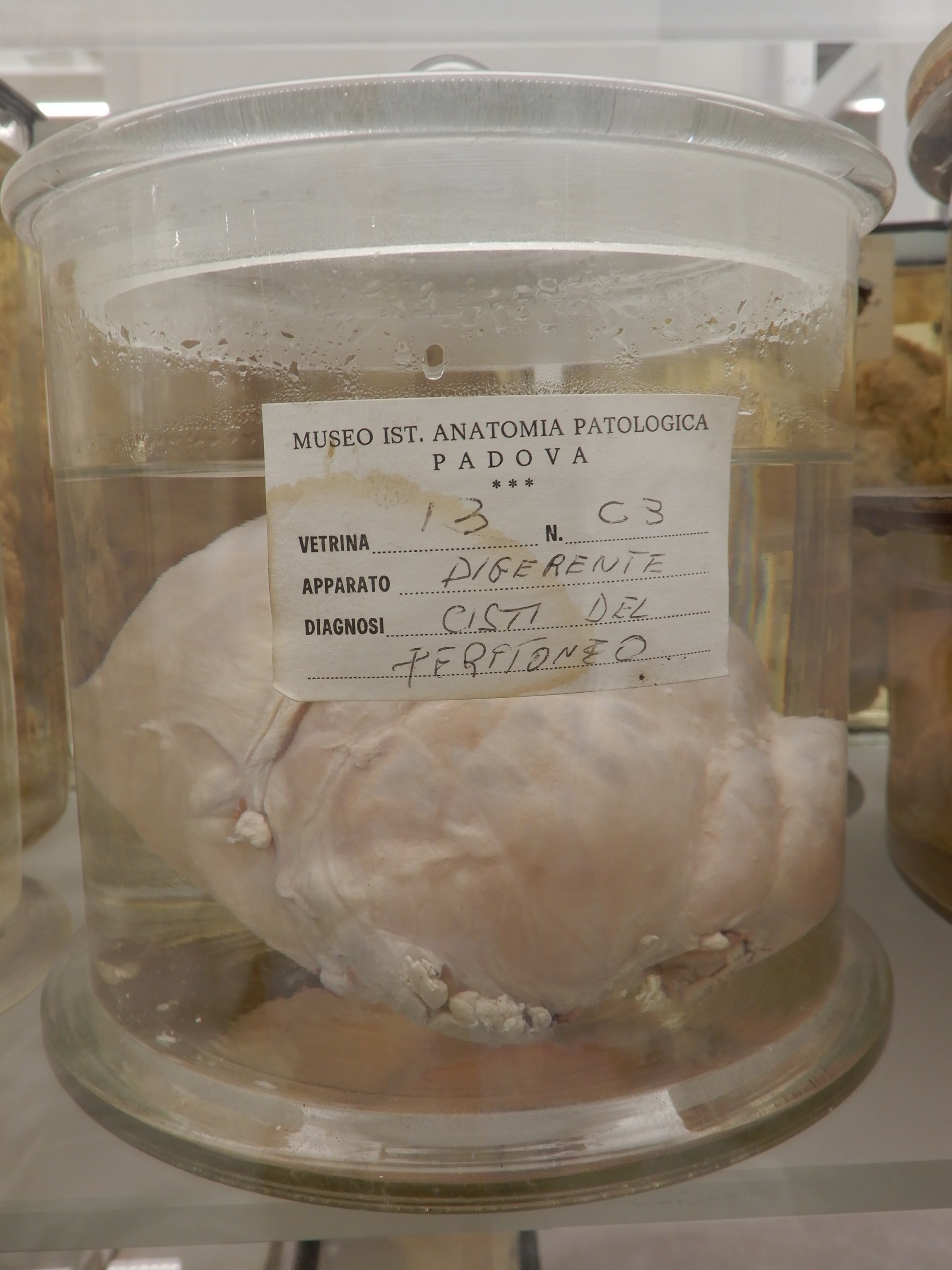 singolo reperto antropologico, preparato anatomico (morfologia alterata per patologia) (XIX-XX)