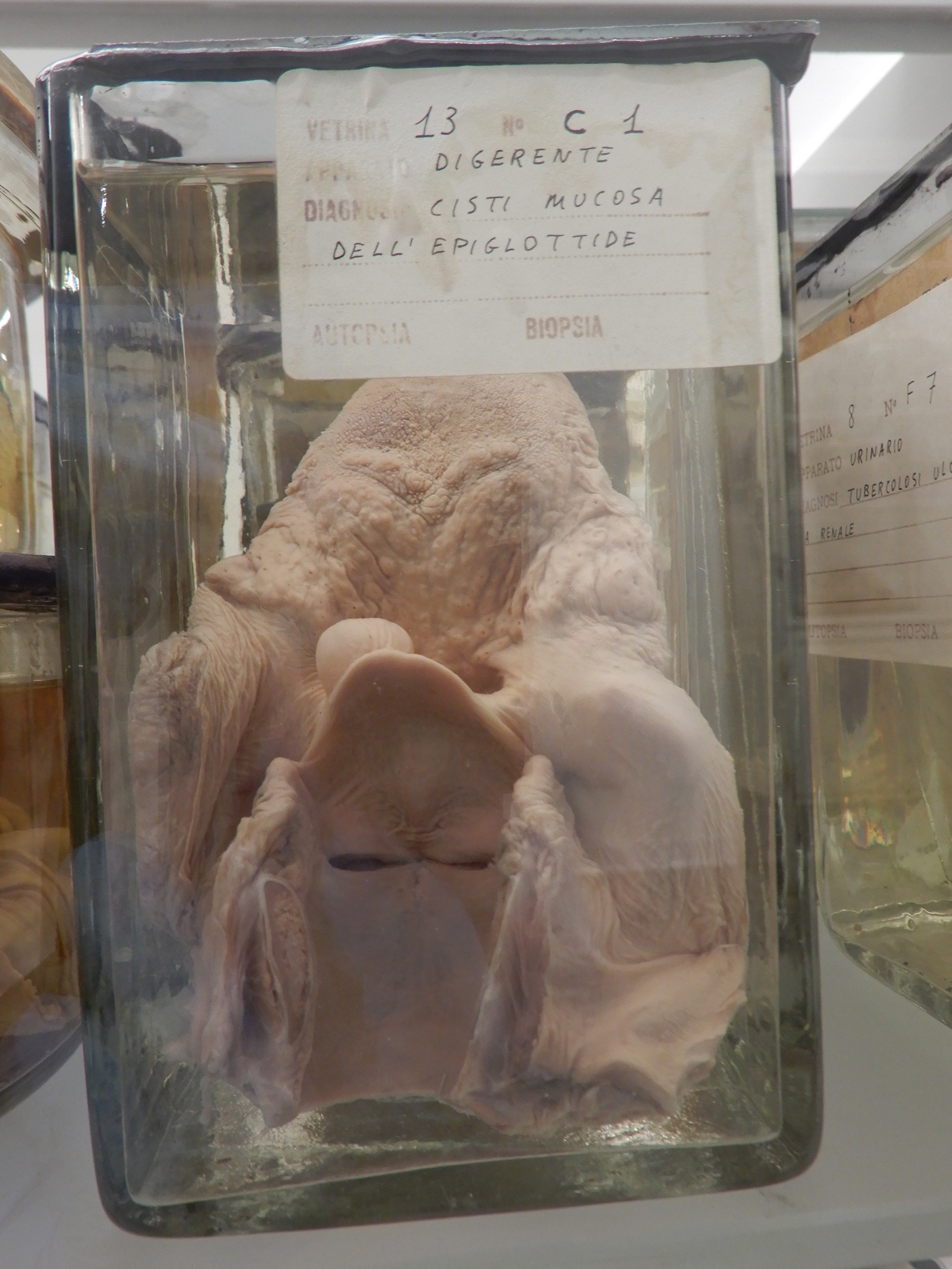 singolo reperto antropologico, preparato anatomico (morfologia alterata per patologia) (XIX-XX)