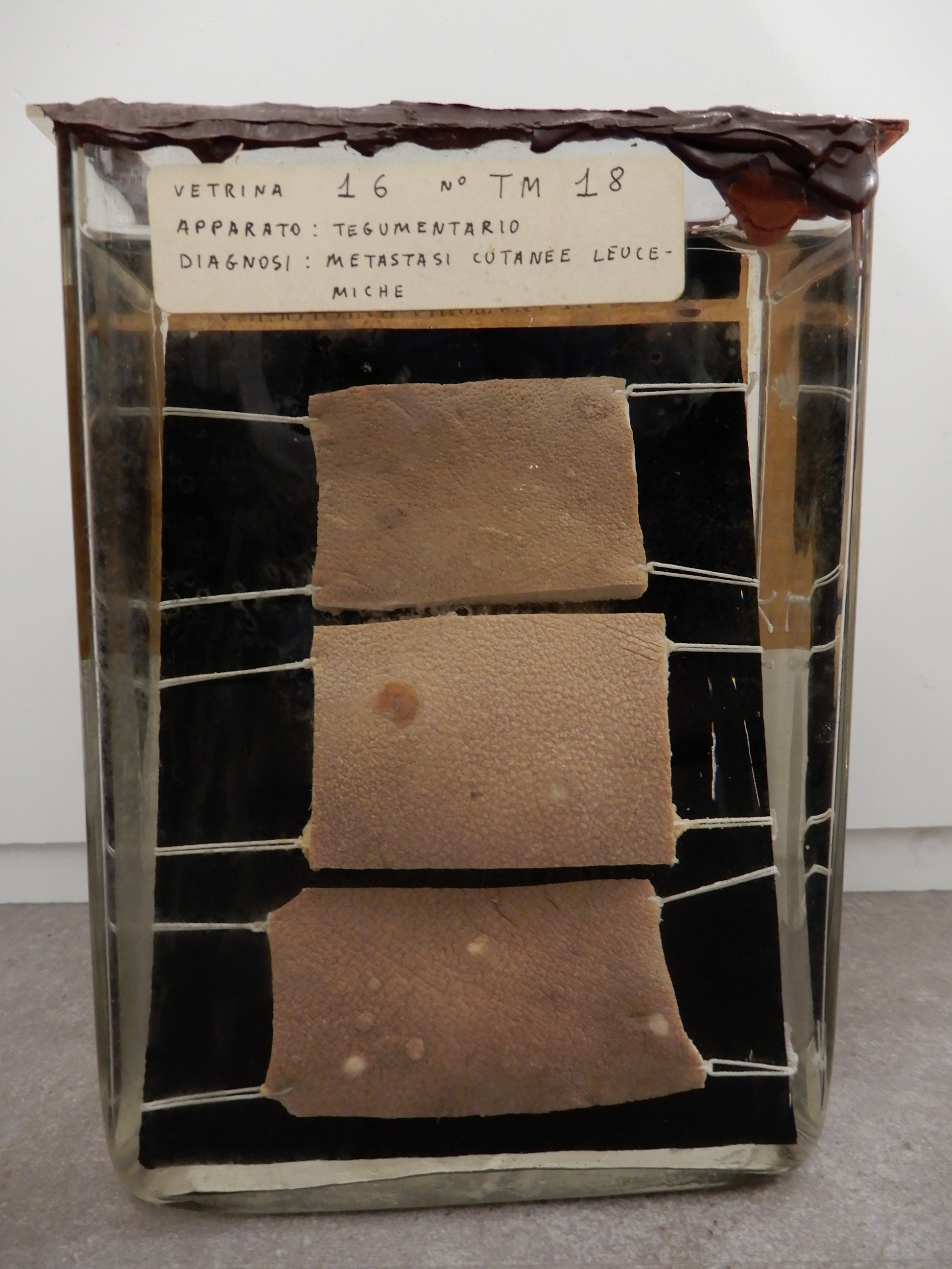 singolo reperto antropologico, preparato anatomico (morfologia alterata per patologia) (XIX-XX)