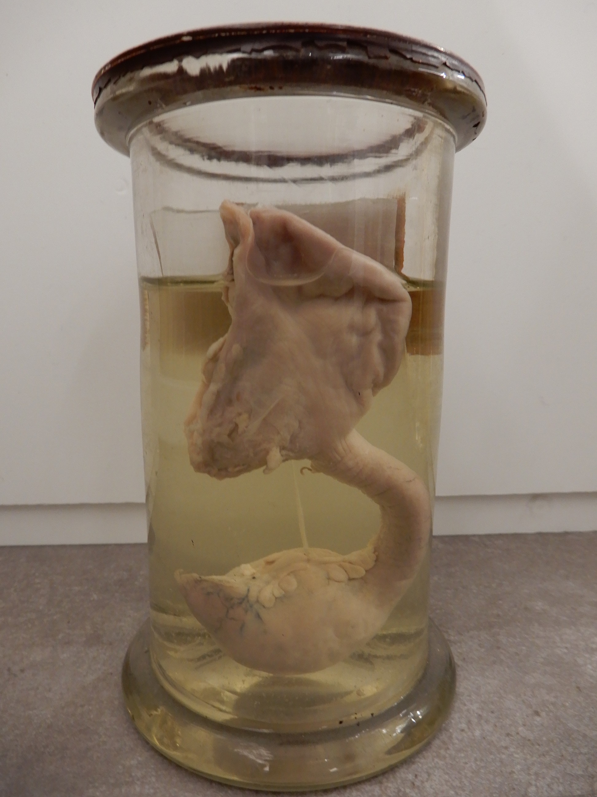 singolo reperto antropologico, preparato anatomico (morfologia alterata per patologia) (XIX-XX)