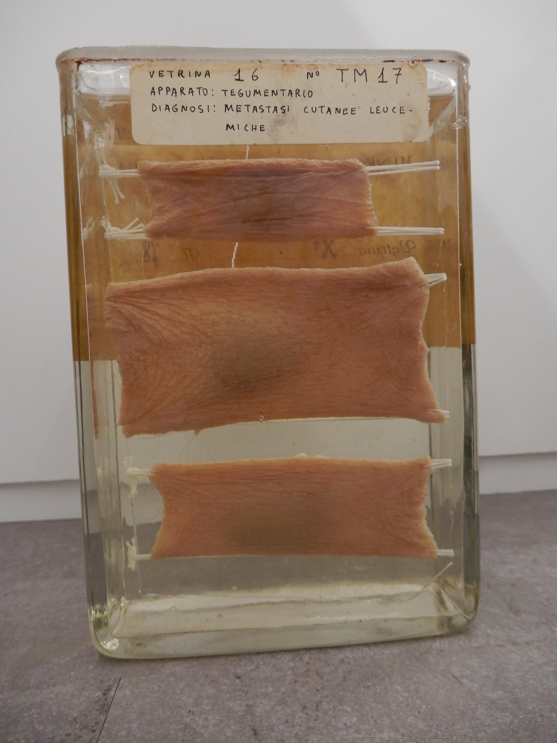 singolo reperto antropologico, preparato anatomico (morfologia alterata per patologia) (XIX-XX)