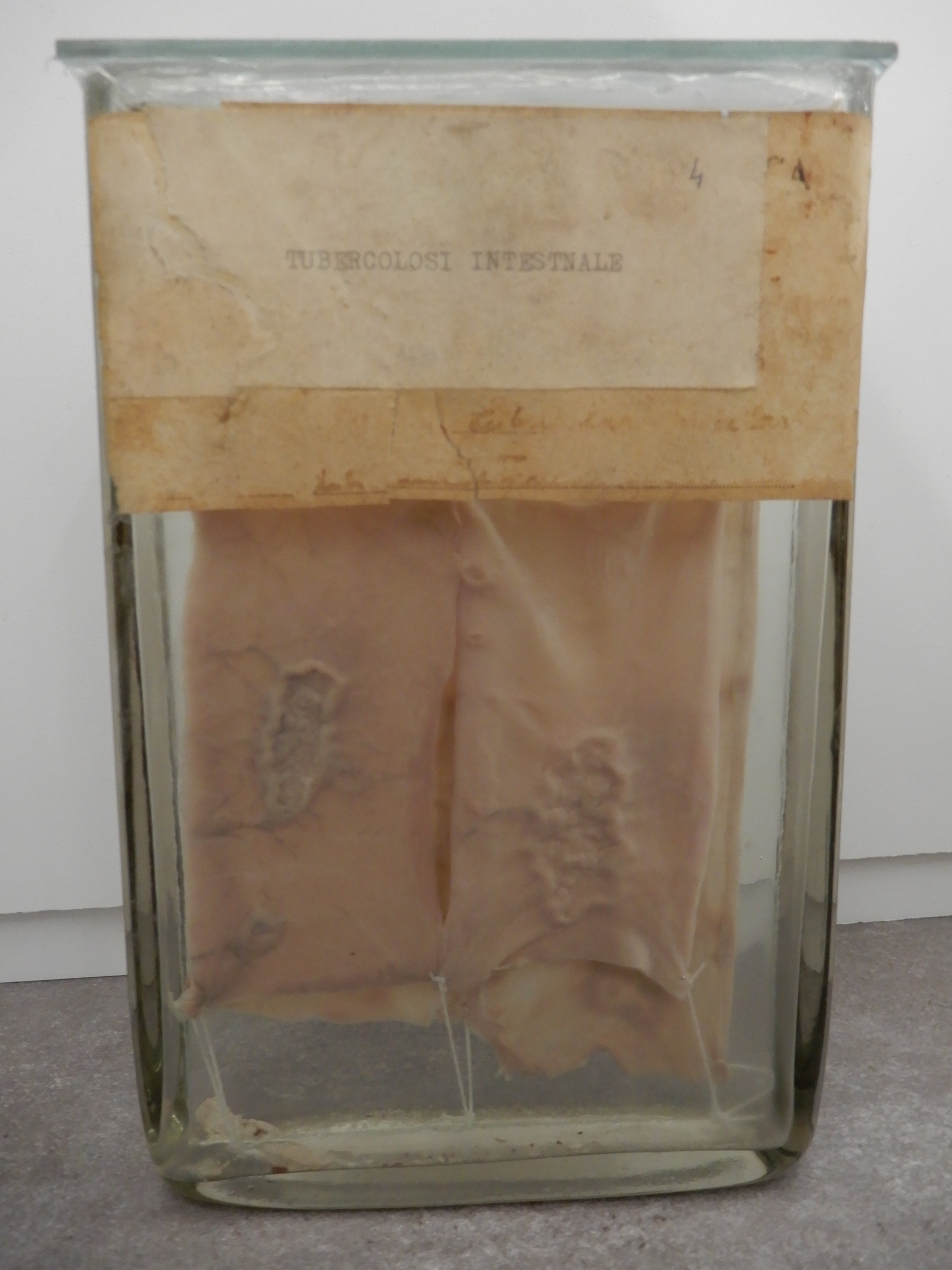 singolo reperto antropologico, preparato anatomico (morfologia alterata per patologia) (XIX-XX)