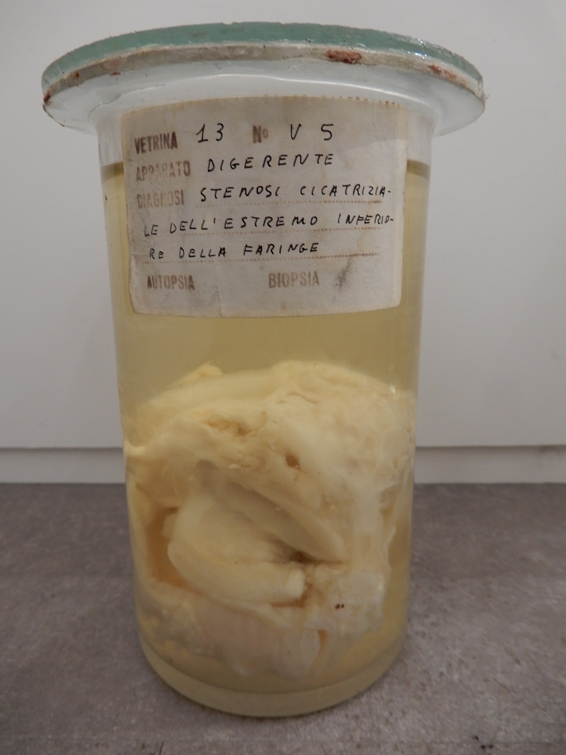 singolo reperto antropologico, preparato anatomico (morfologia alterata per patologia) (XIX-XX)