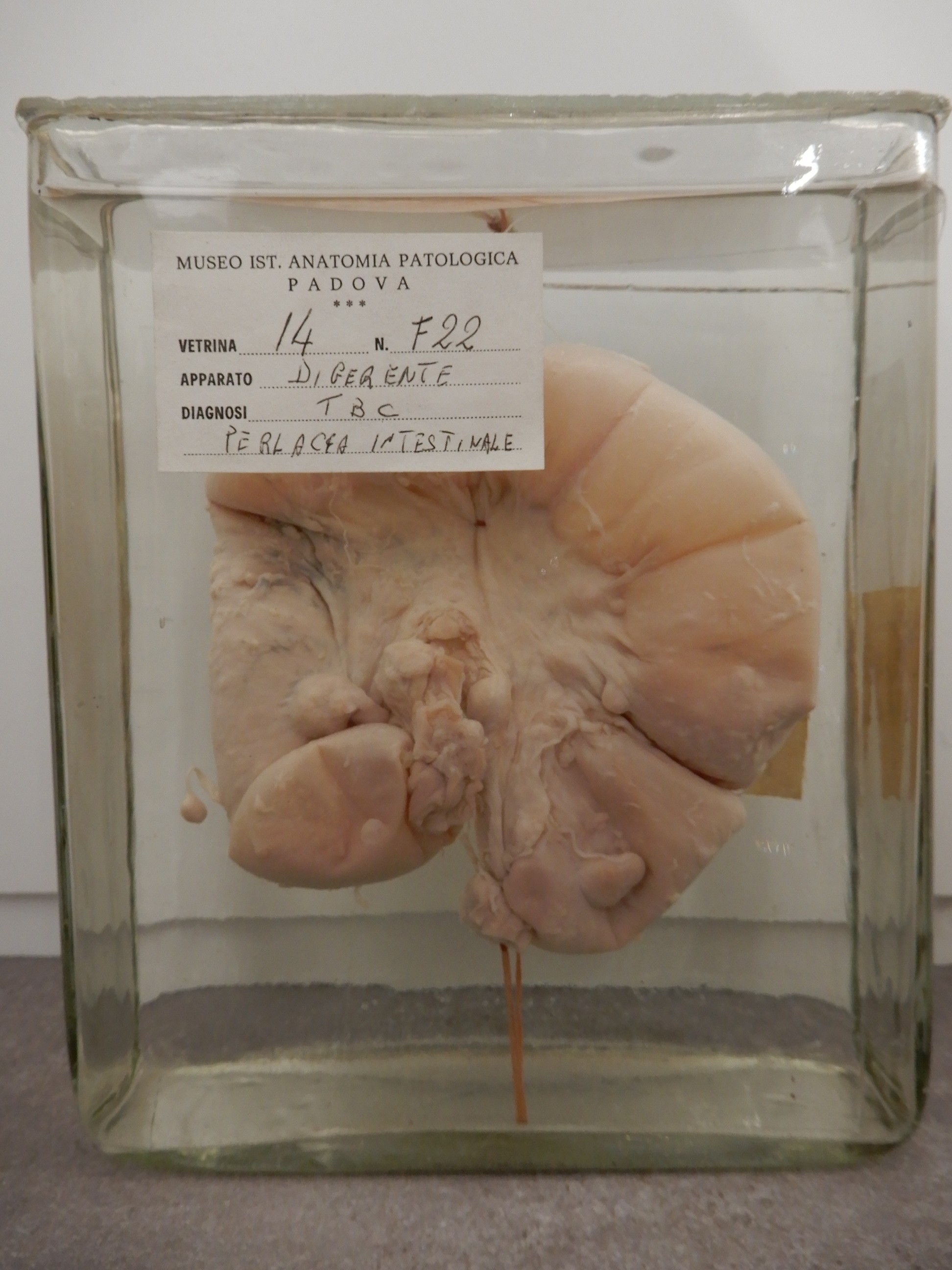 singolo reperto antropologico, preparato anatomico (morfologia alterata per patologia) (XIX-XX)