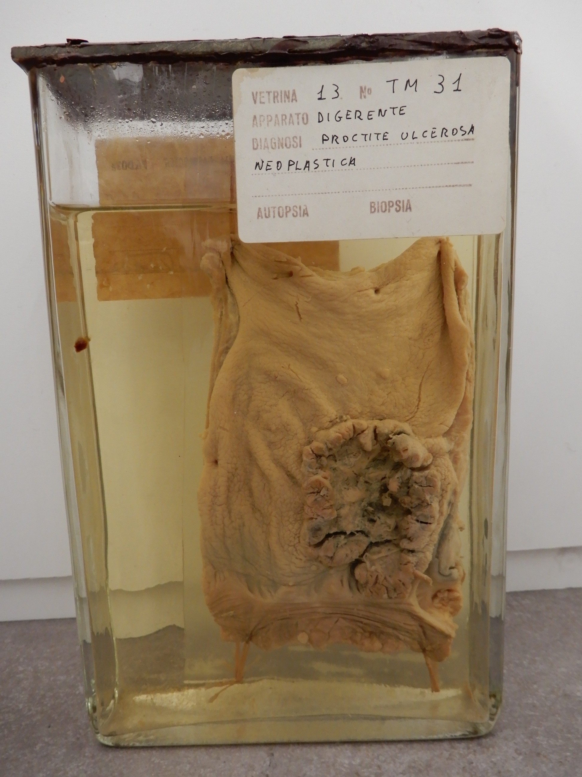 singolo reperto antropologico, preparato anatomico (morfologia alterata per patologia) (XIX-XX)