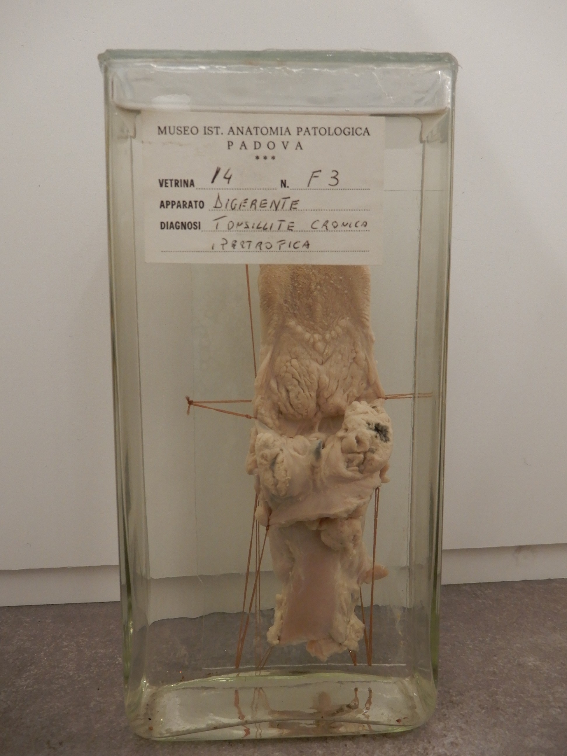 singolo reperto antropologico, preparato anatomico (morfologia alterata per patologia) (XIX-XX)