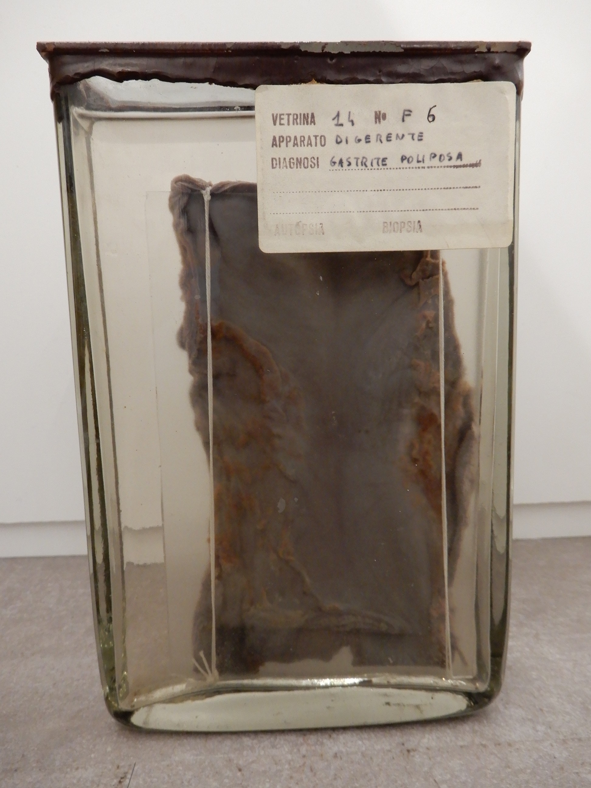 singolo reperto antropologico, preparato anatomico (morfologia alterata per patologia) (XIX-XX)