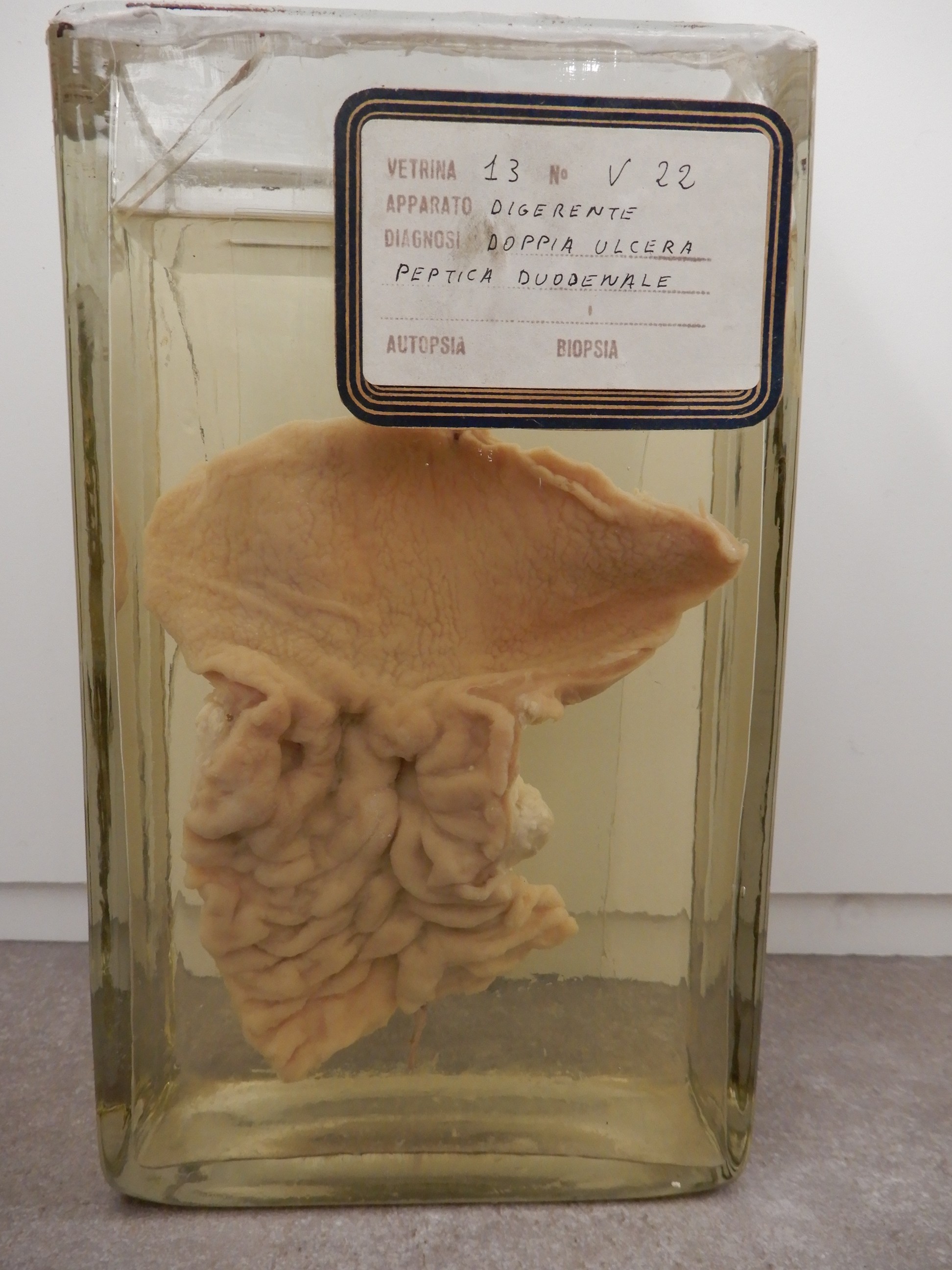 singolo reperto antropologico, preparato anatomico (morfologia alterata per patologia) (XIX-XX)