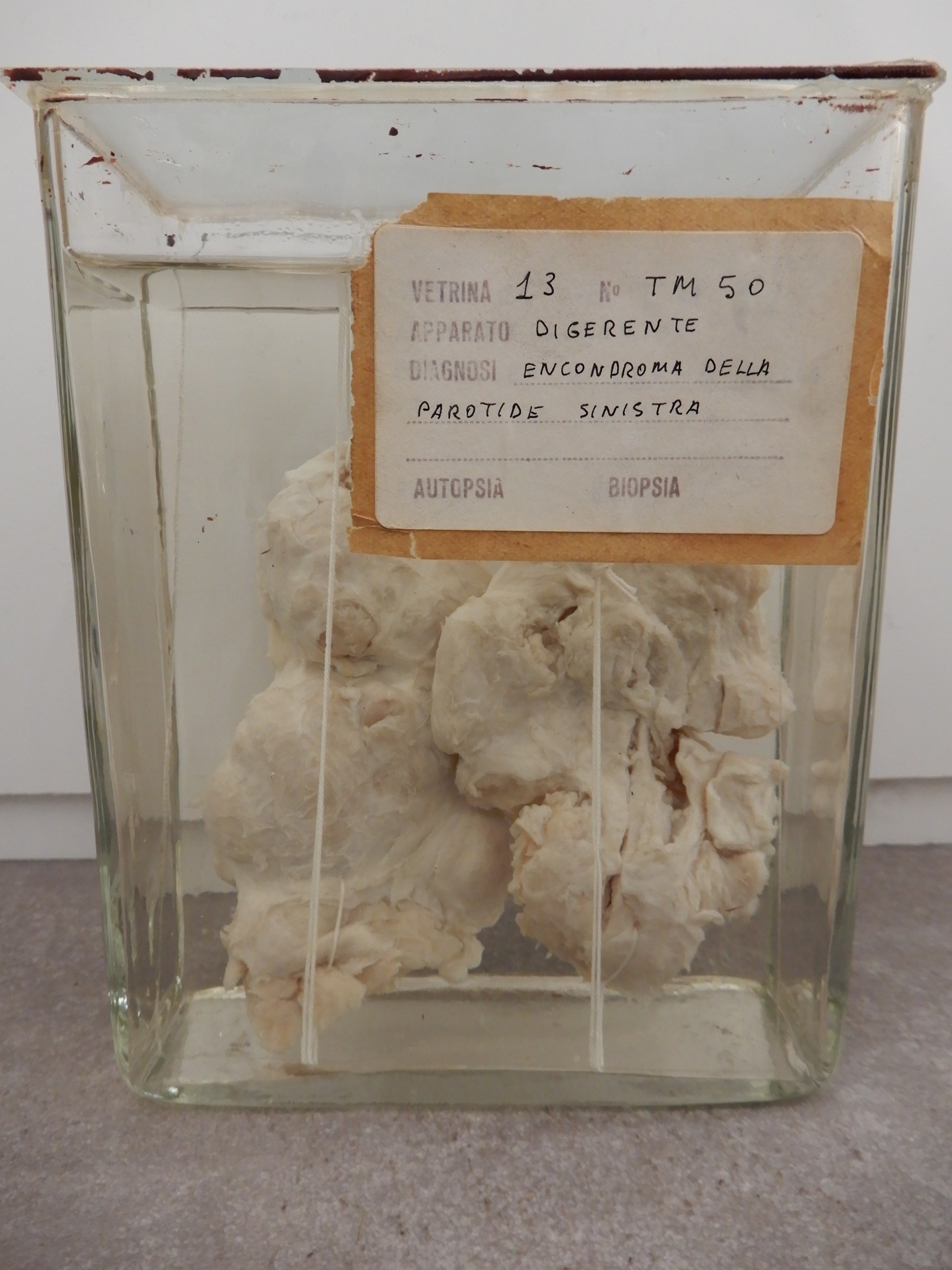 singolo reperto antropologico, preparato anatomico (morfologia alterata per patologia) (XIX-XX)