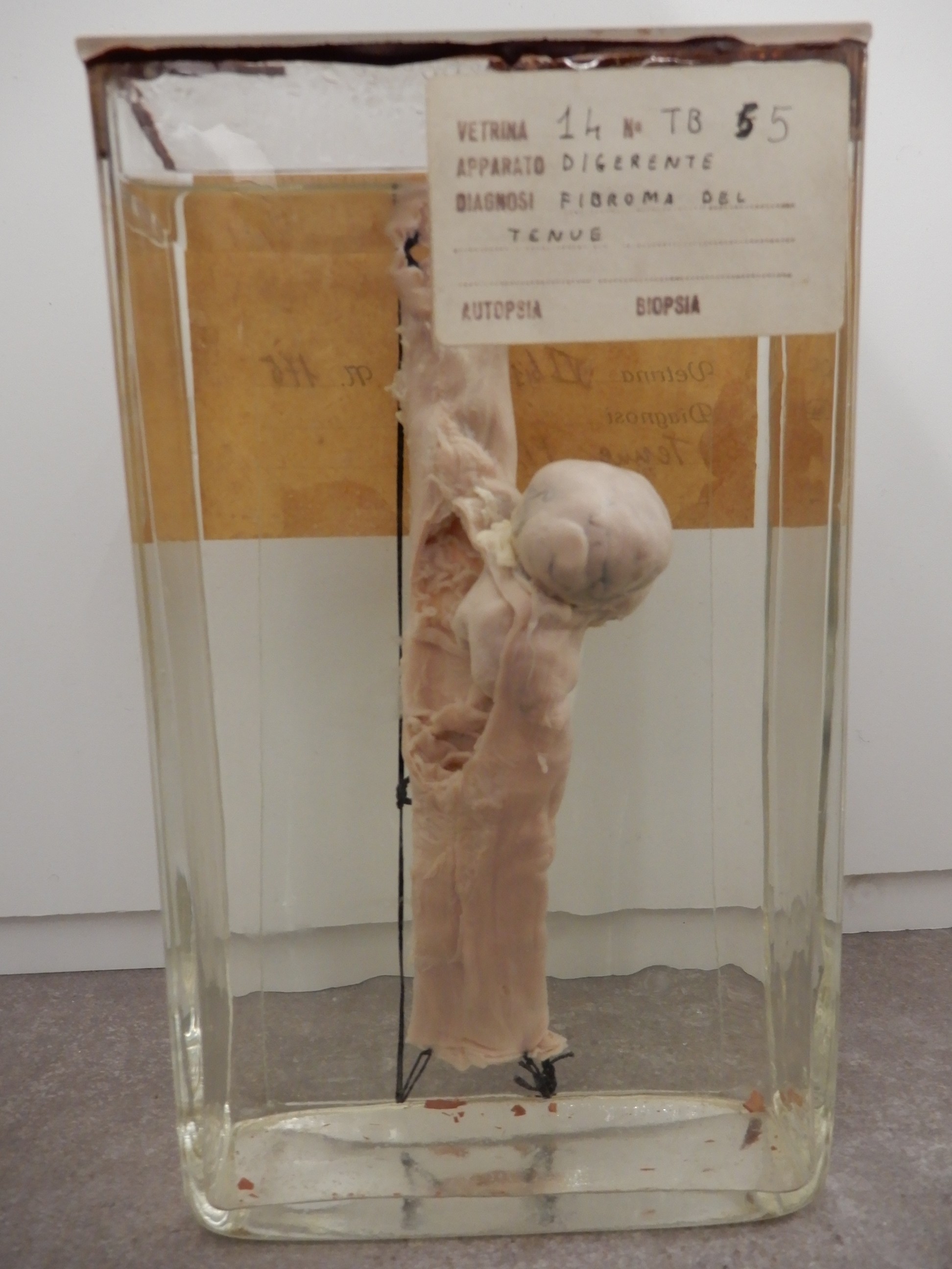 singolo reperto antropologico, preparato anatomico (morfologia alterata per patologia) (XIX-XX)