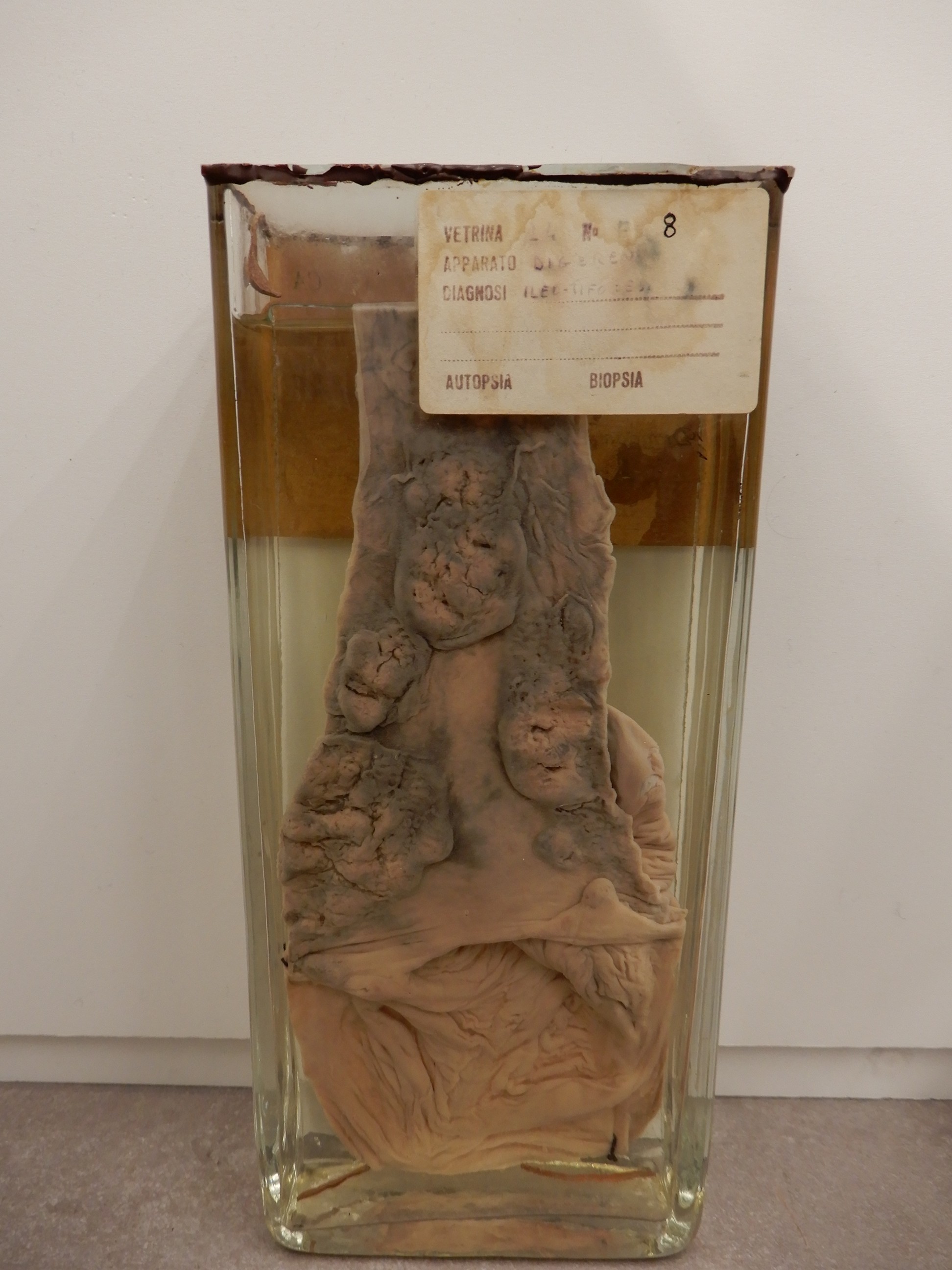 singolo reperto antropologico, preparato anatomico (morfologia alterata per patologia) (XIX-XX)