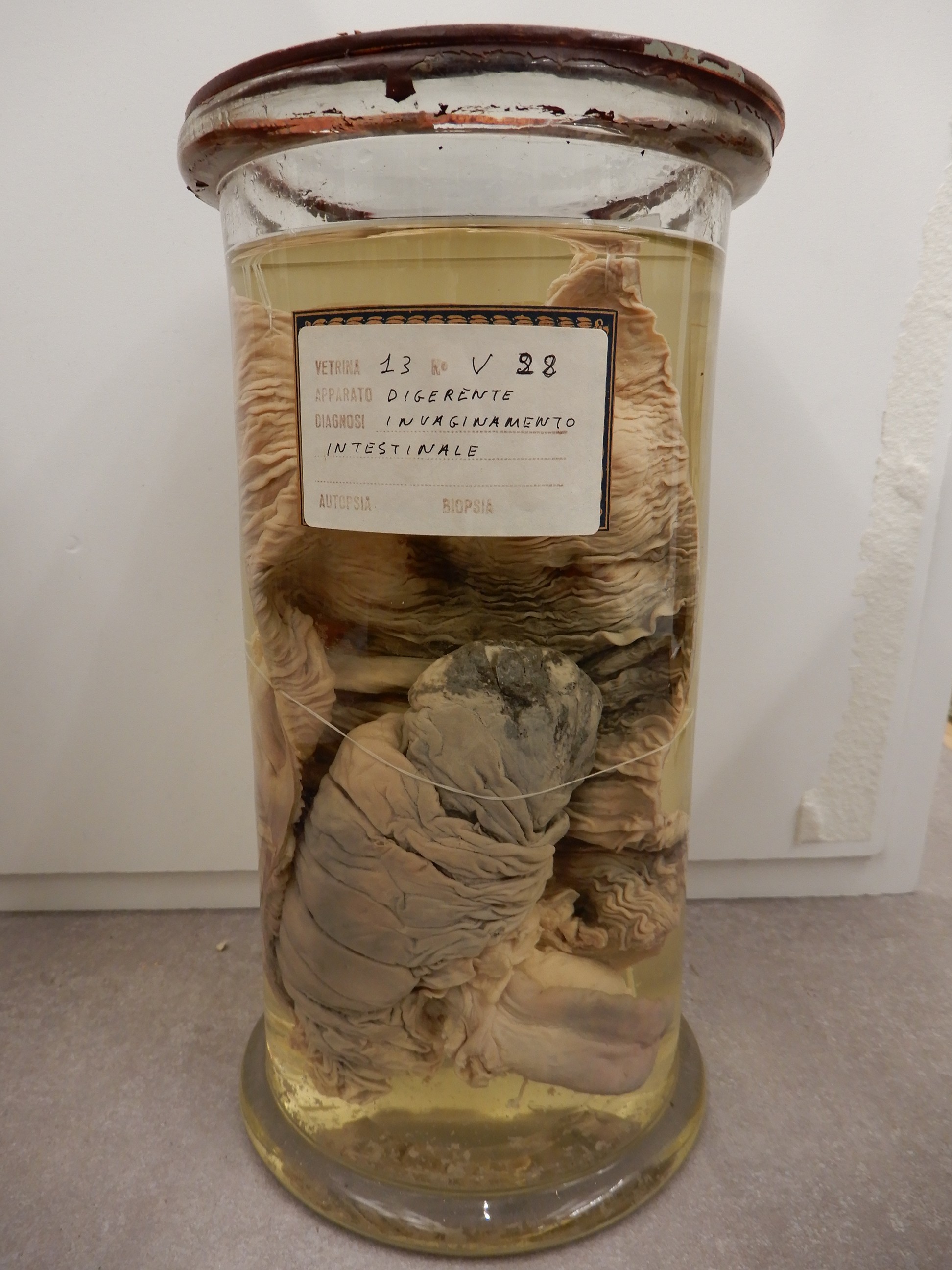 singolo reperto antropologico, preparato anatomico (morfologia alterata per patologia) (XIX-XX)