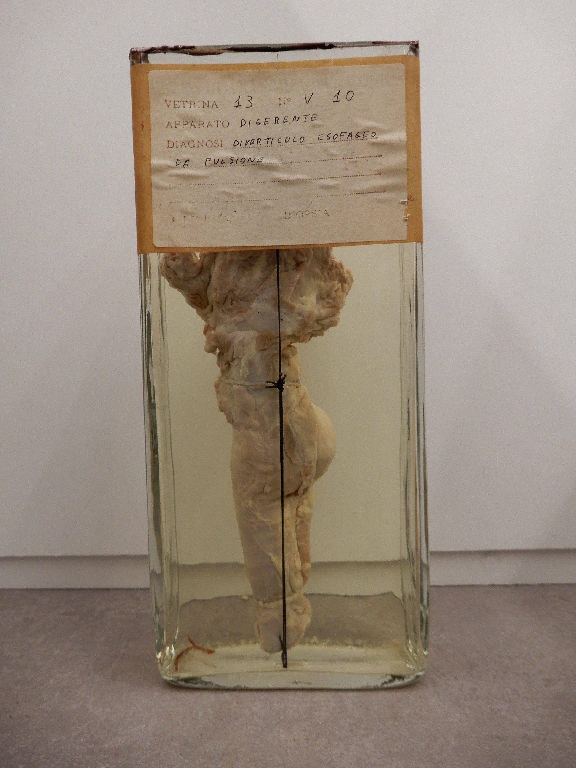 singolo reperto antropologico, preparato anatomico (morfologia alterata per patologia) (XIX-XX)