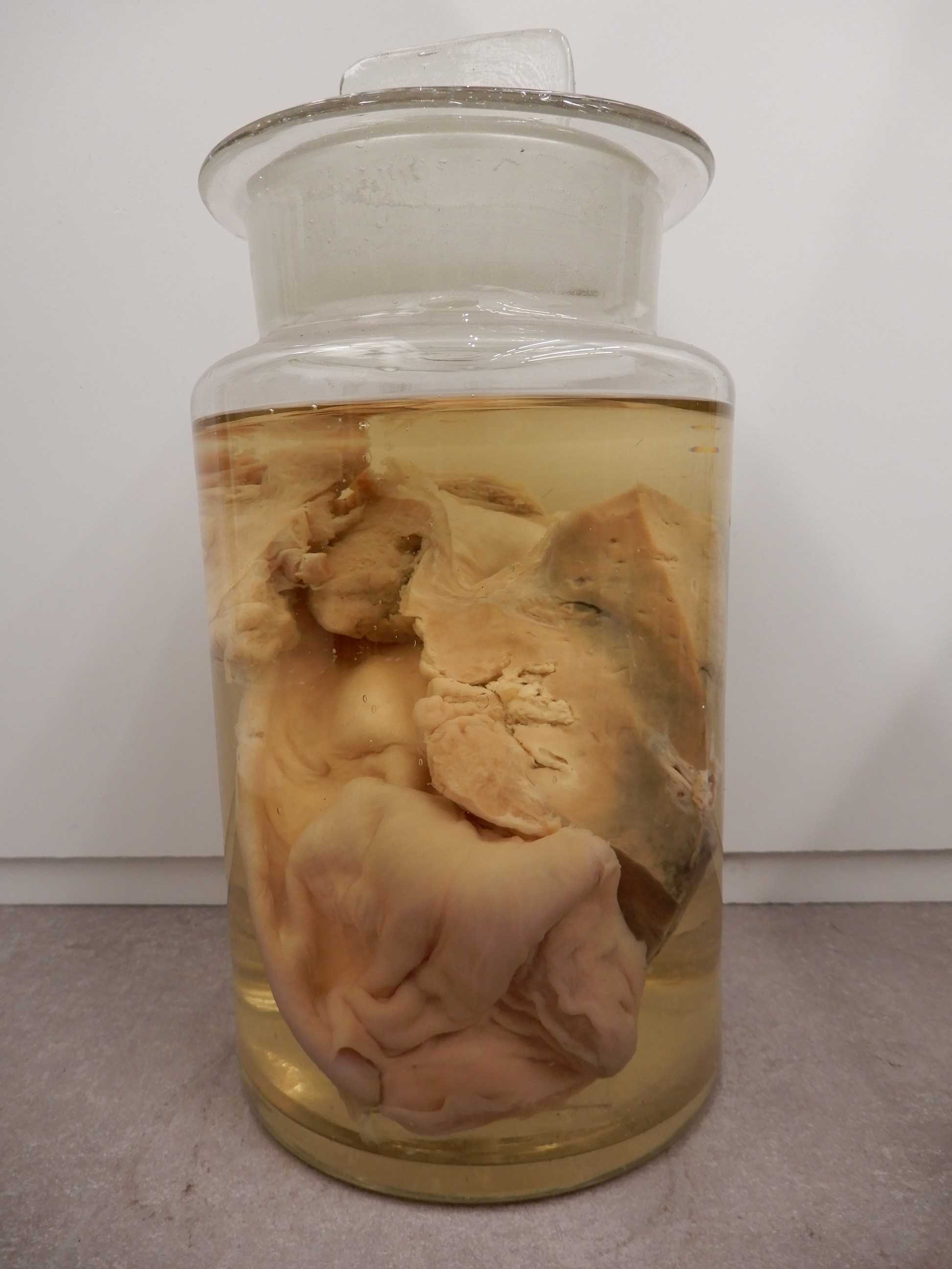 singolo reperto antropologico, preparato anatomico (morfologia alterata per patologia) (XIX-XX)