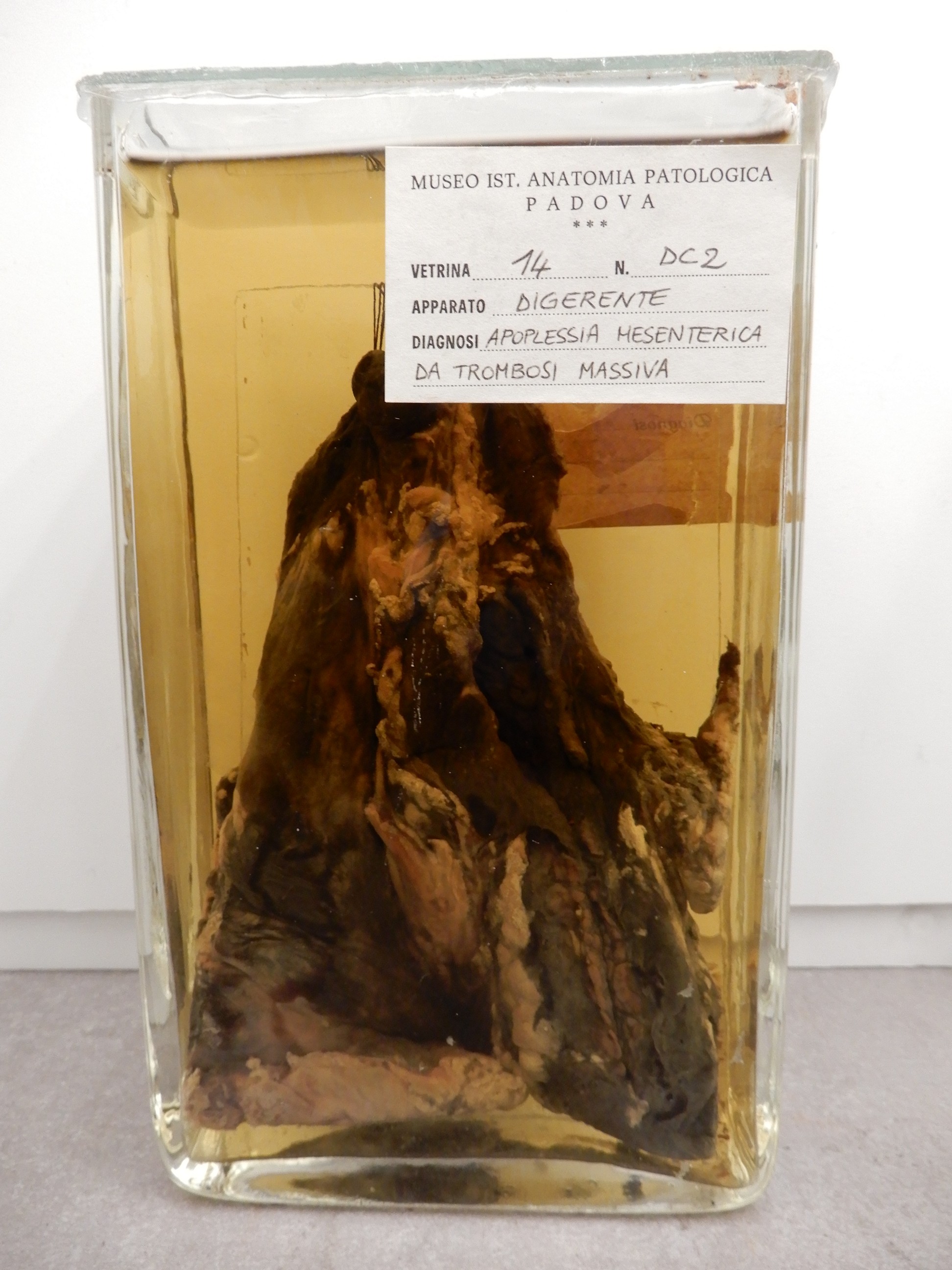 singolo reperto antropologico, preparato anatomico (morfologia alterata per patologia) (XIX-XX)