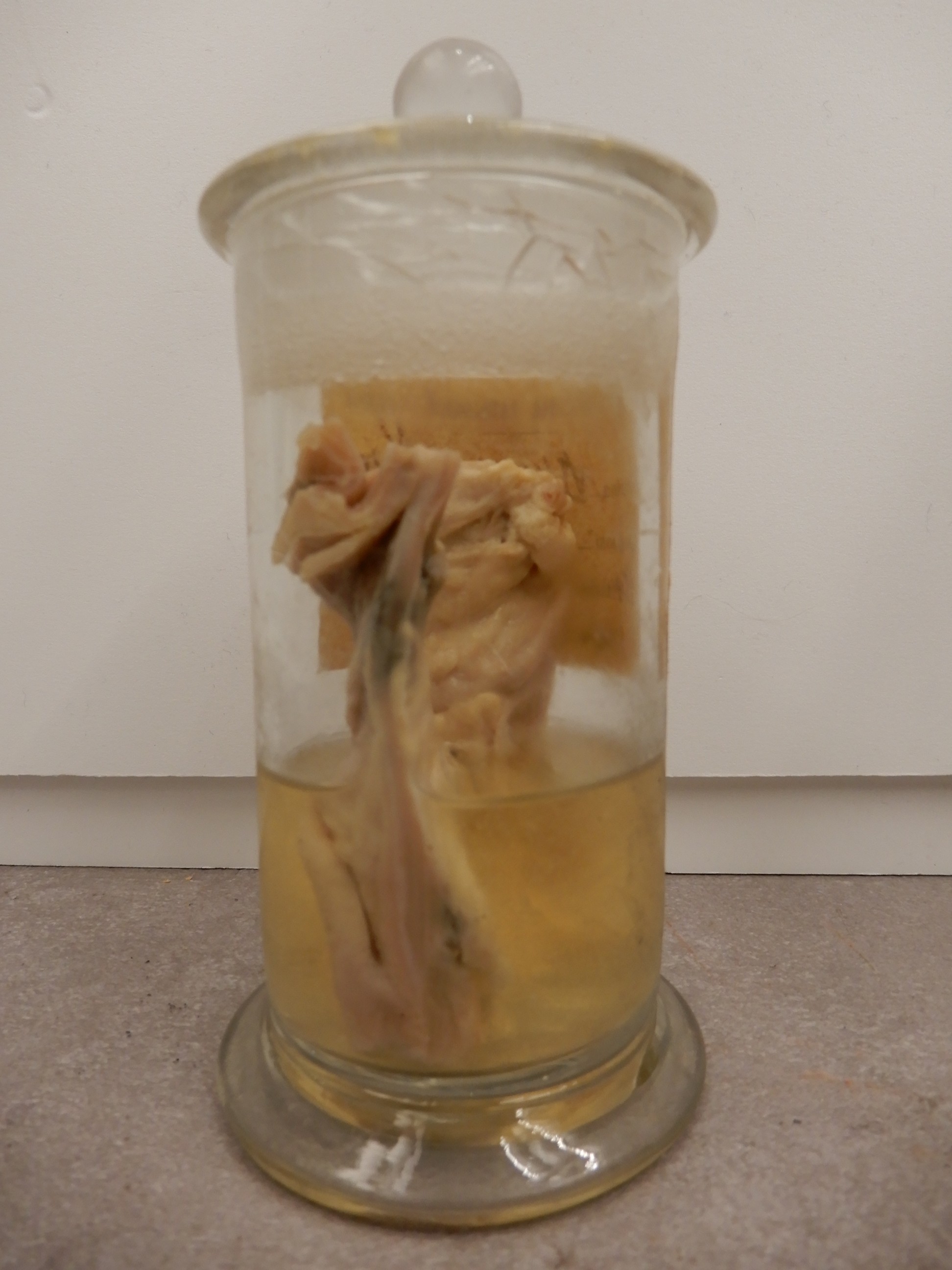 singolo reperto antropologico, preparato anatomico (morfologia alterata per patologia) (XIX-XX)